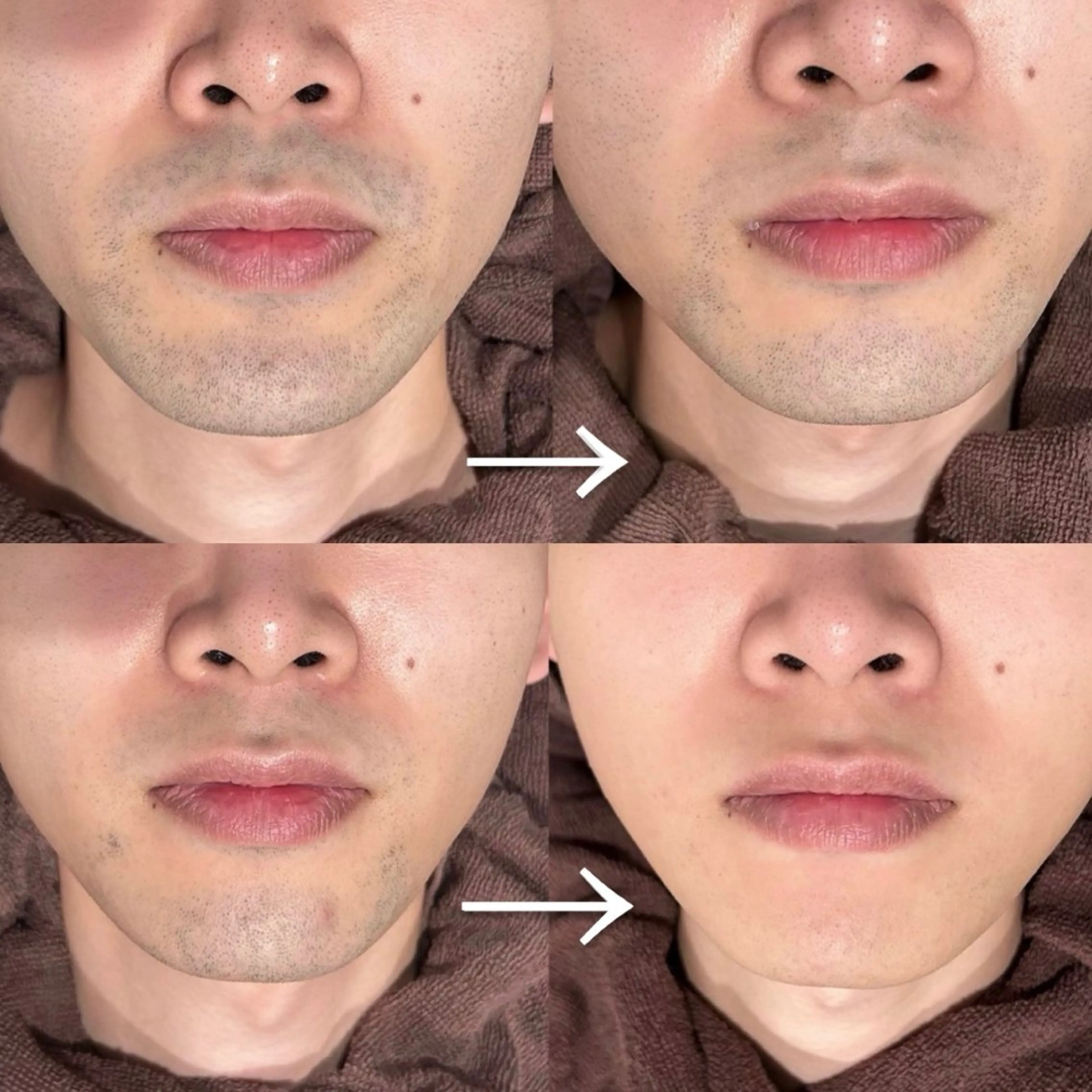 【まずはお試し🆗】men's美肌ヒゲ脱毛(顎/鼻下/頬/首/もみあげ)の写真