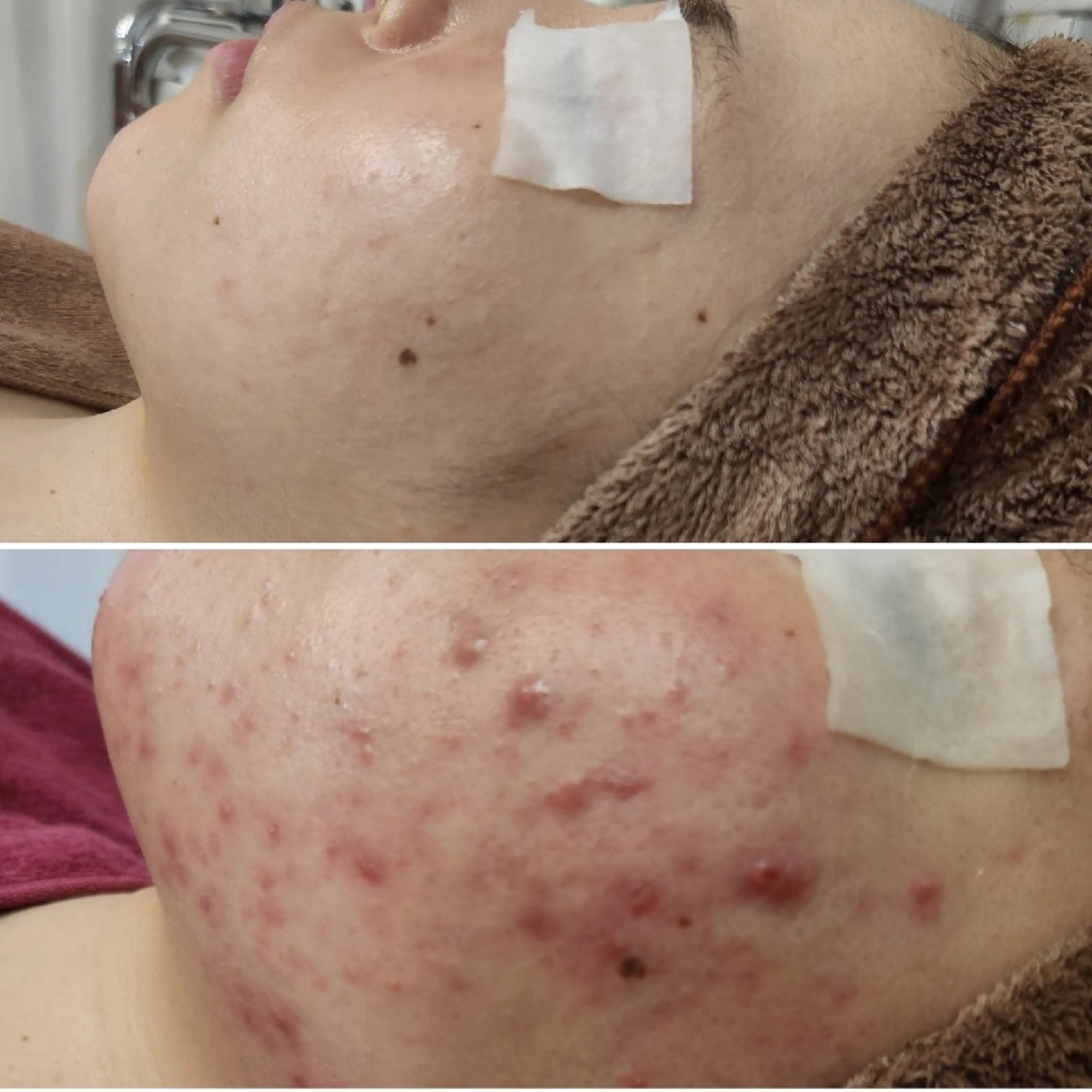 水光肌スペシャル💙炭酸カーボキシー&ハーブピーリング✨ニキビケアに毛穴の引き締め、小顔効果がUP！の写真