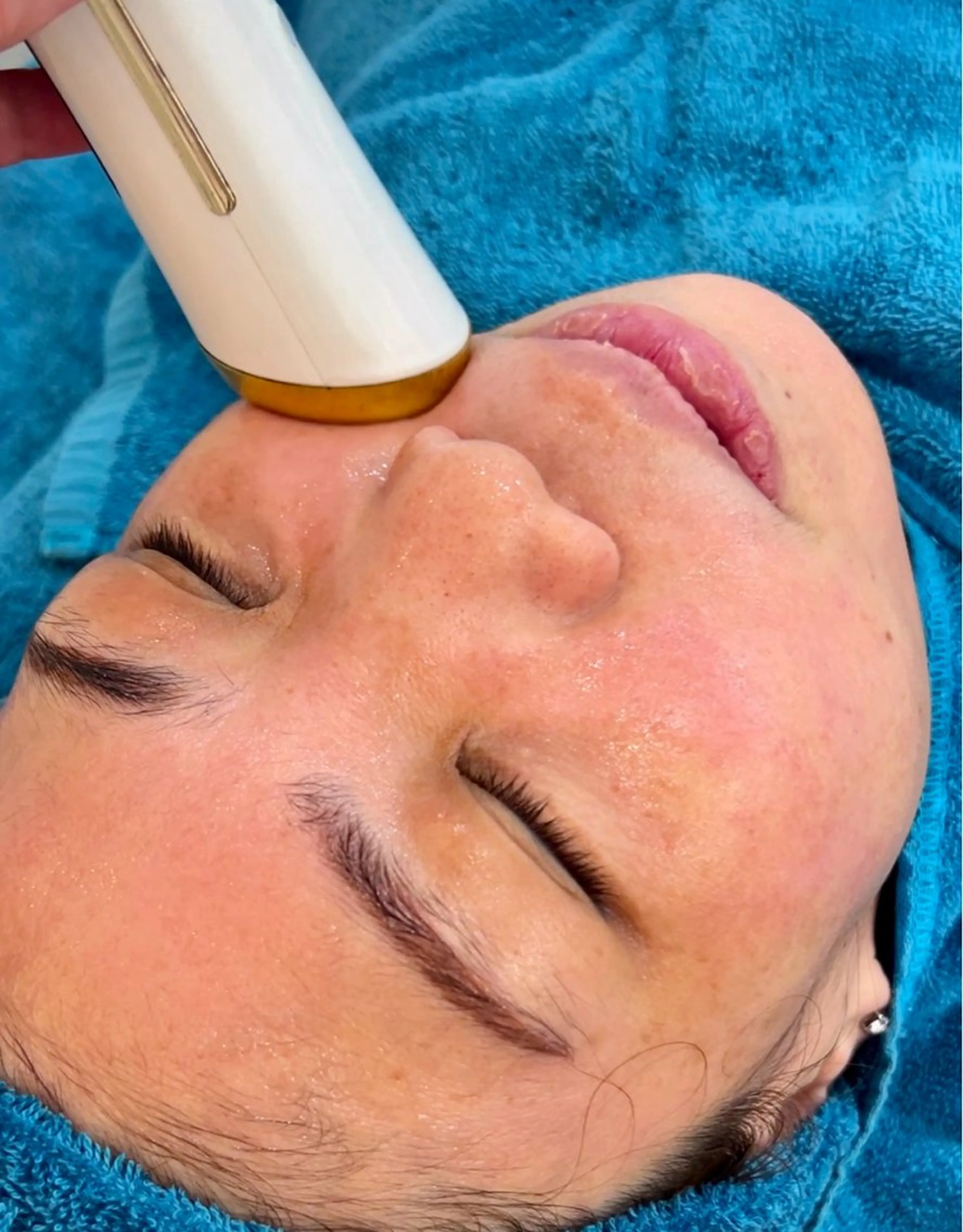 イオン導入 （初回お試し）の写真