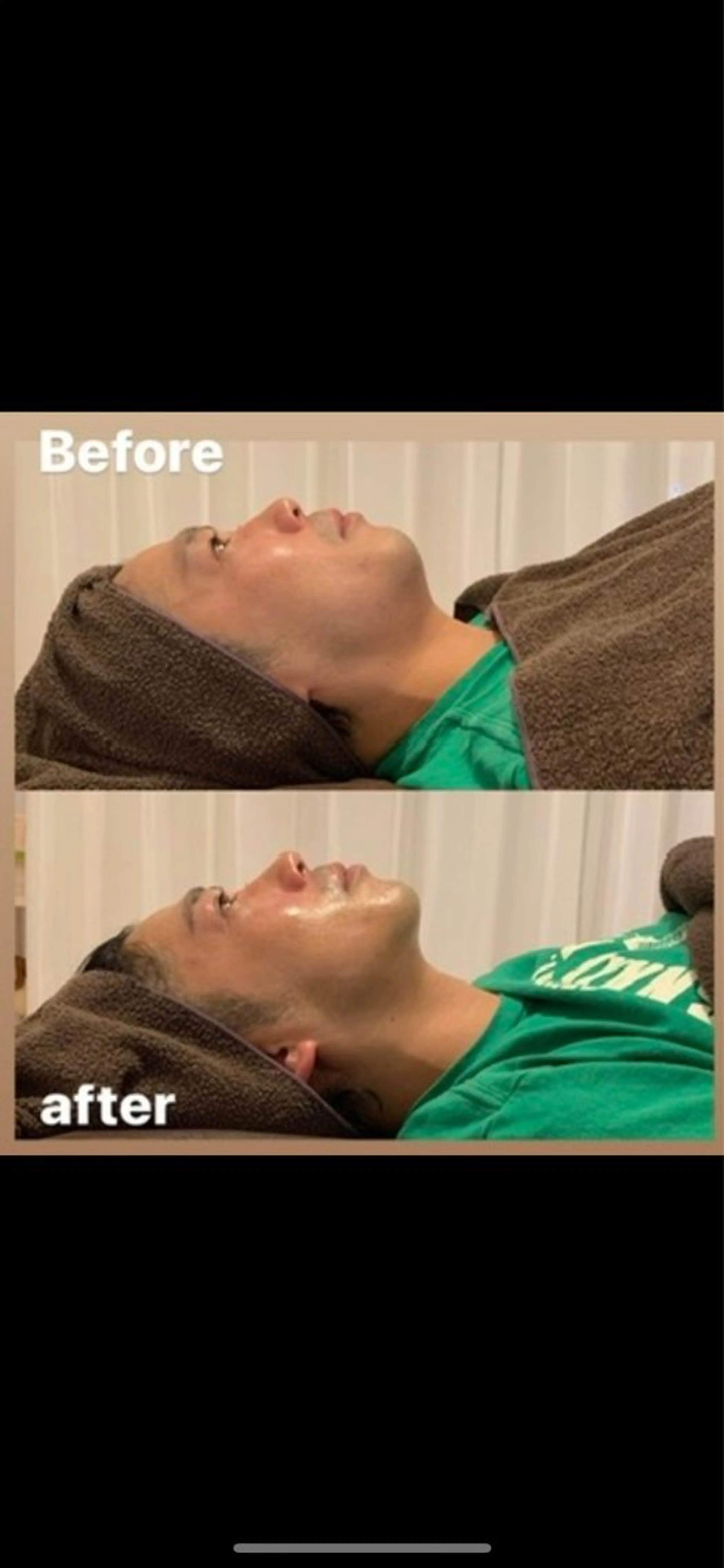 速攻小顔リフトアップフェイシャル！EMSでむくみ取り、引き上げの写真