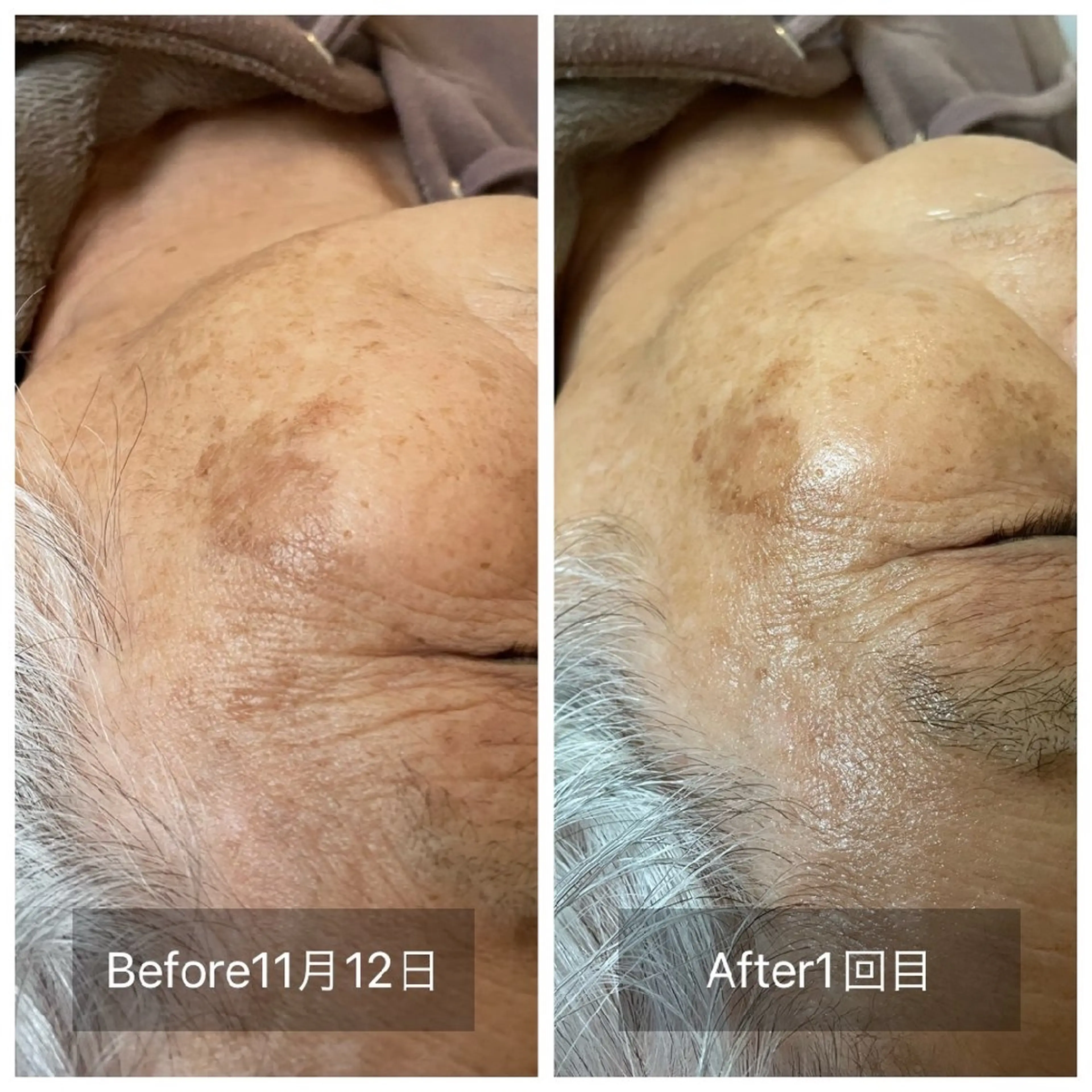 ☆プラズマ美容フェイシャルの写真