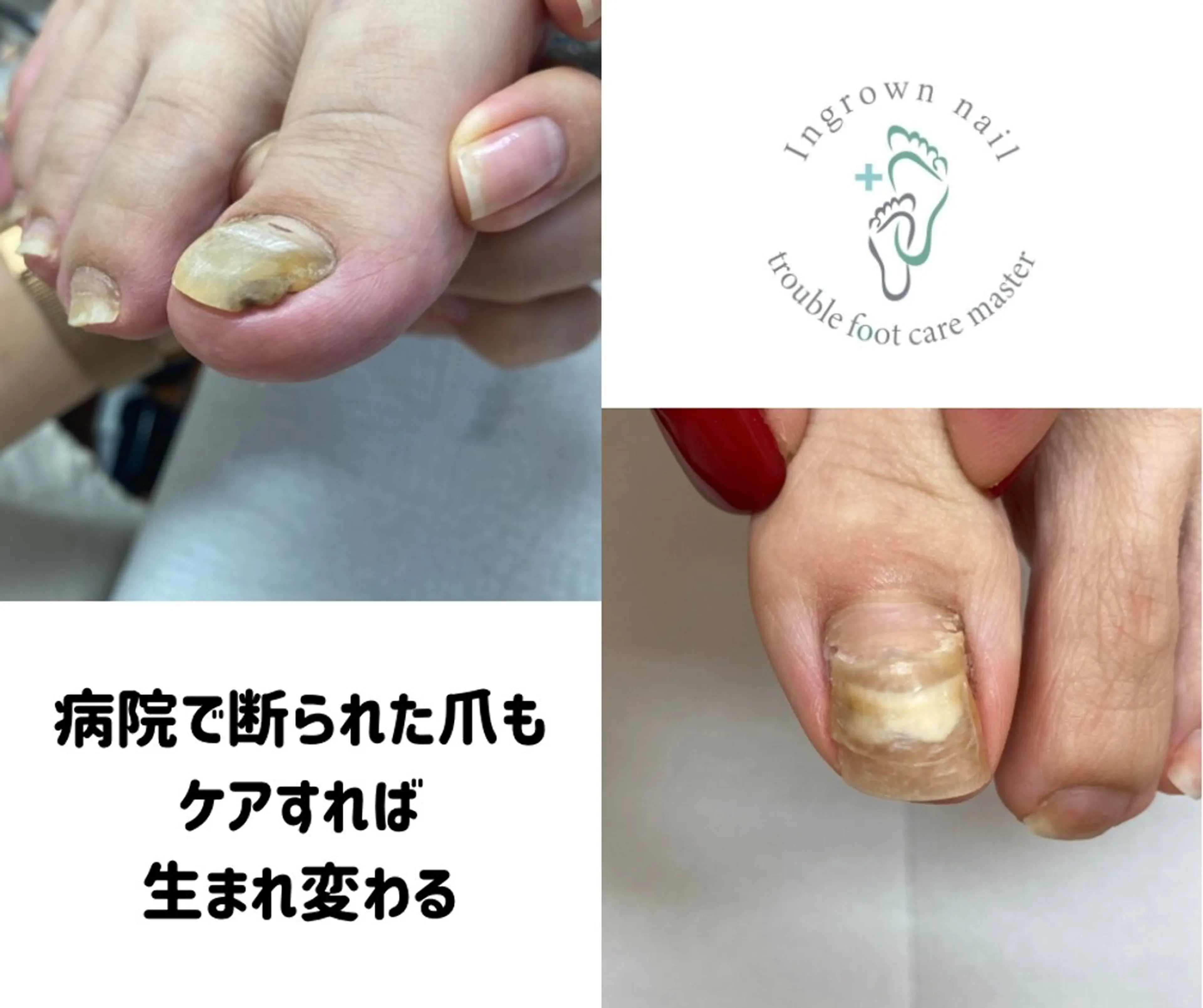 【フットケア】巻き爪/トラブル爪カウンセリングの写真