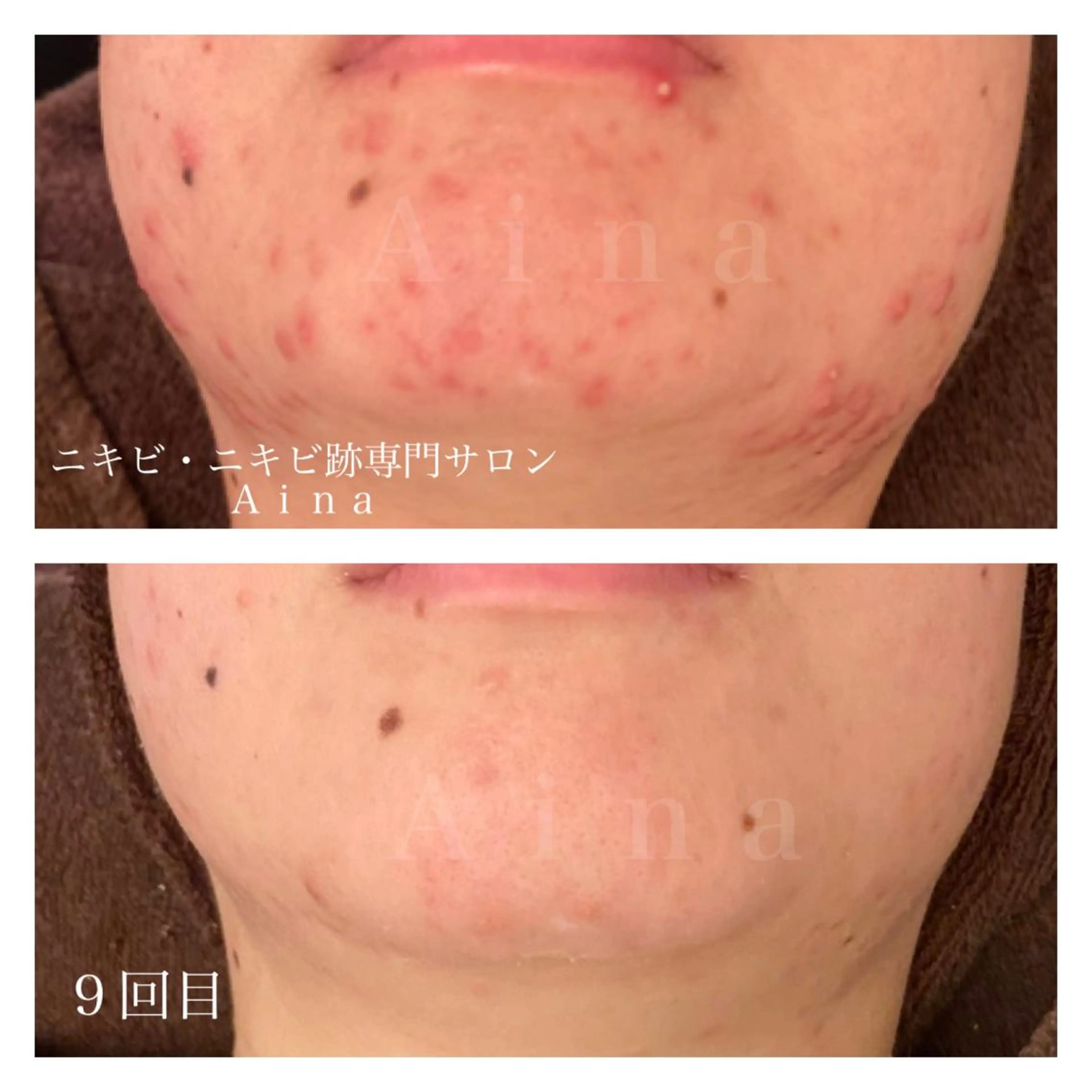 セミロング パーマ ヘアアレンジ メンズ キッズ ネイル マツエク・マツパ アイブロウ エステ リラク ニキビ跡専門サロン Ainaのエステ・リラクイメージ