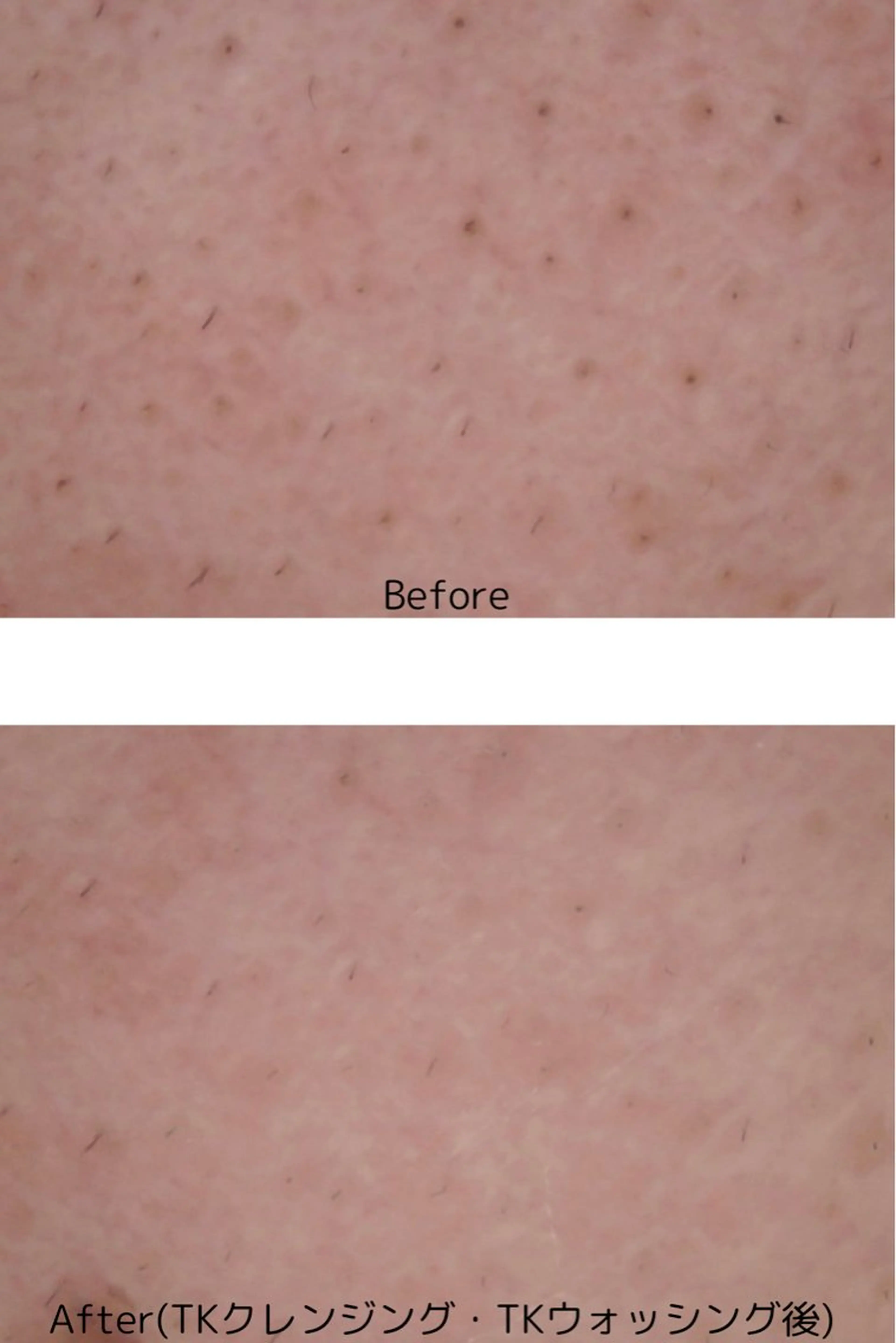 毛穴ケアモニターの写真