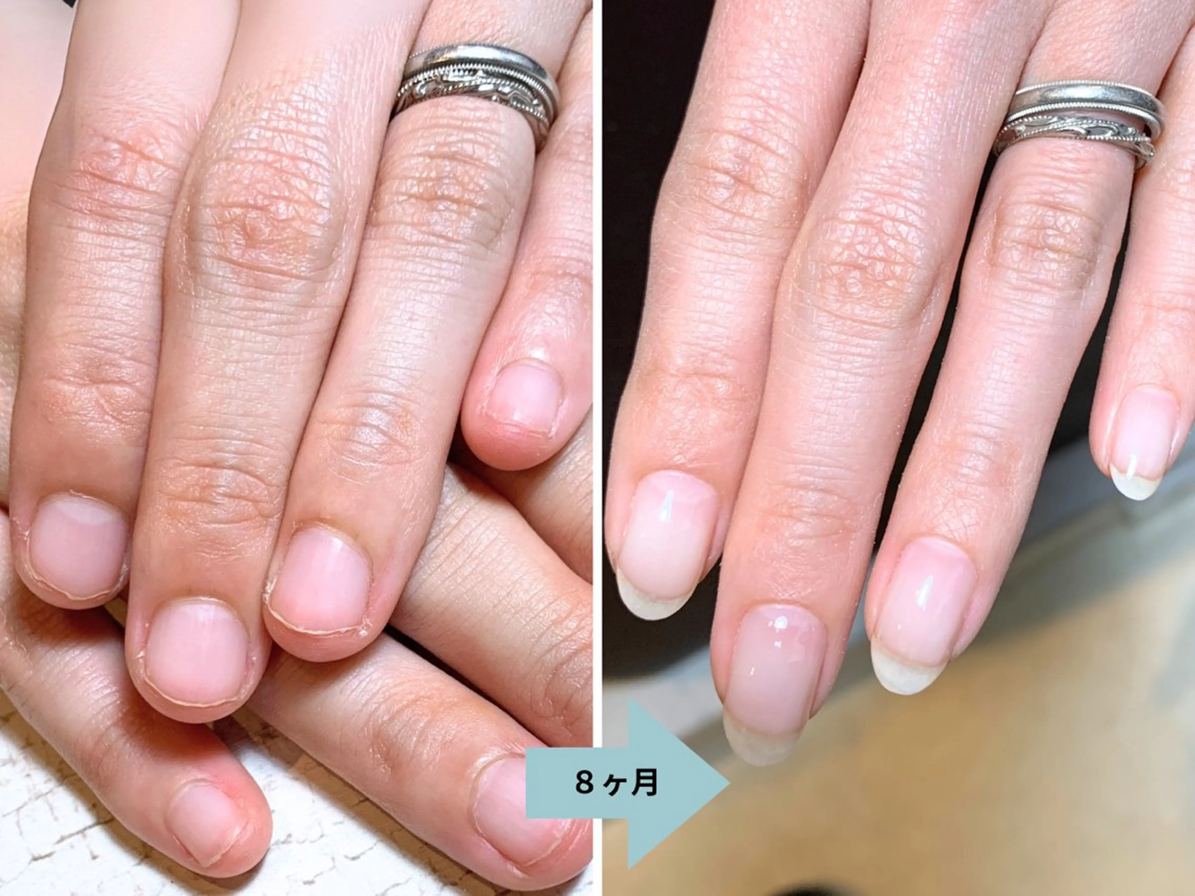 ネイル 深爪矯正・自爪育成 ネイルサロンアモここのネイルデザイン