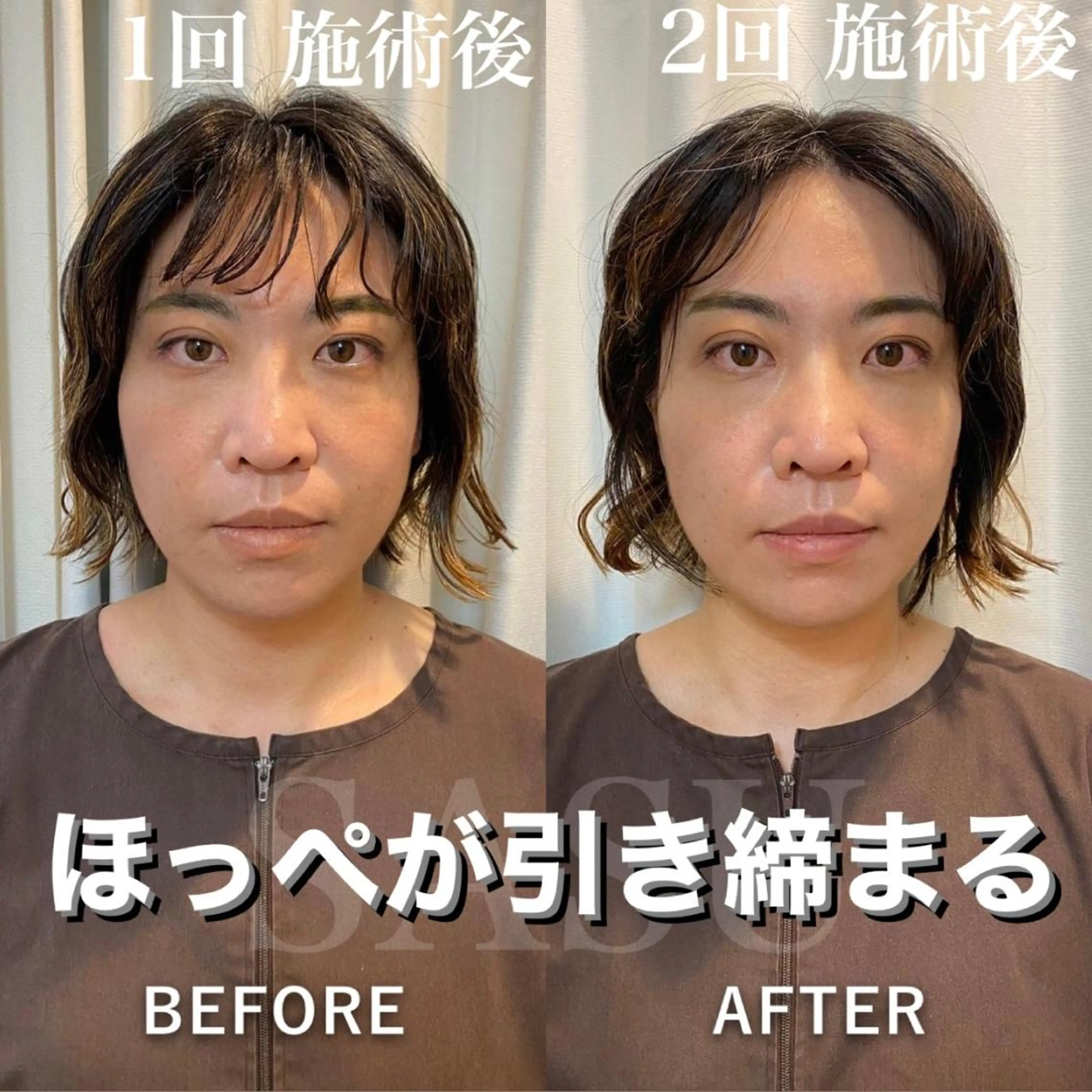 メンズ アイブロウ メンズ韓国風 その他 即小顔♥️美容鍼× ハーブピーリングのその他イメージ