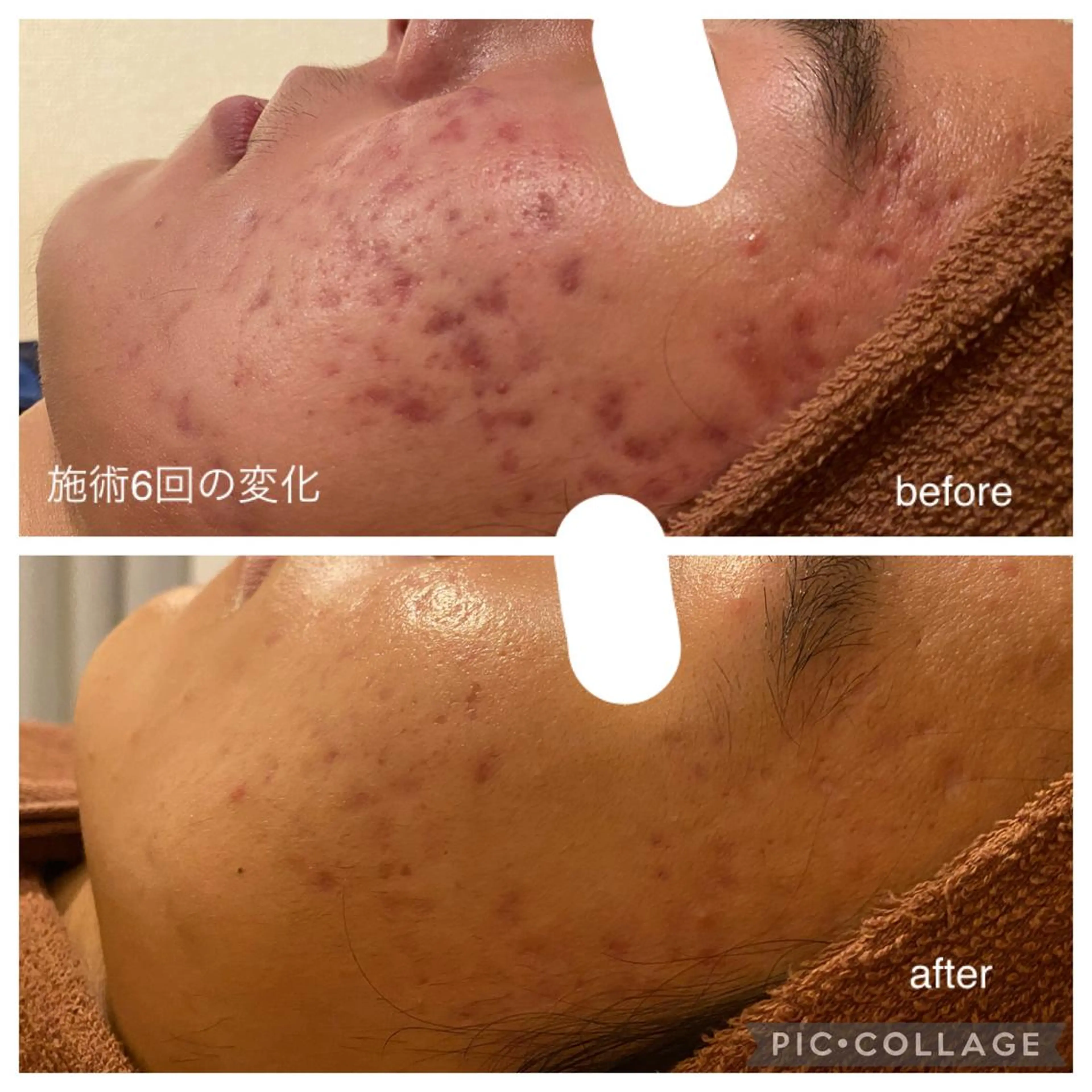 メンズ 夏までに肌荒れ卒業 するサロン🌻のエステ・リラクイメージ