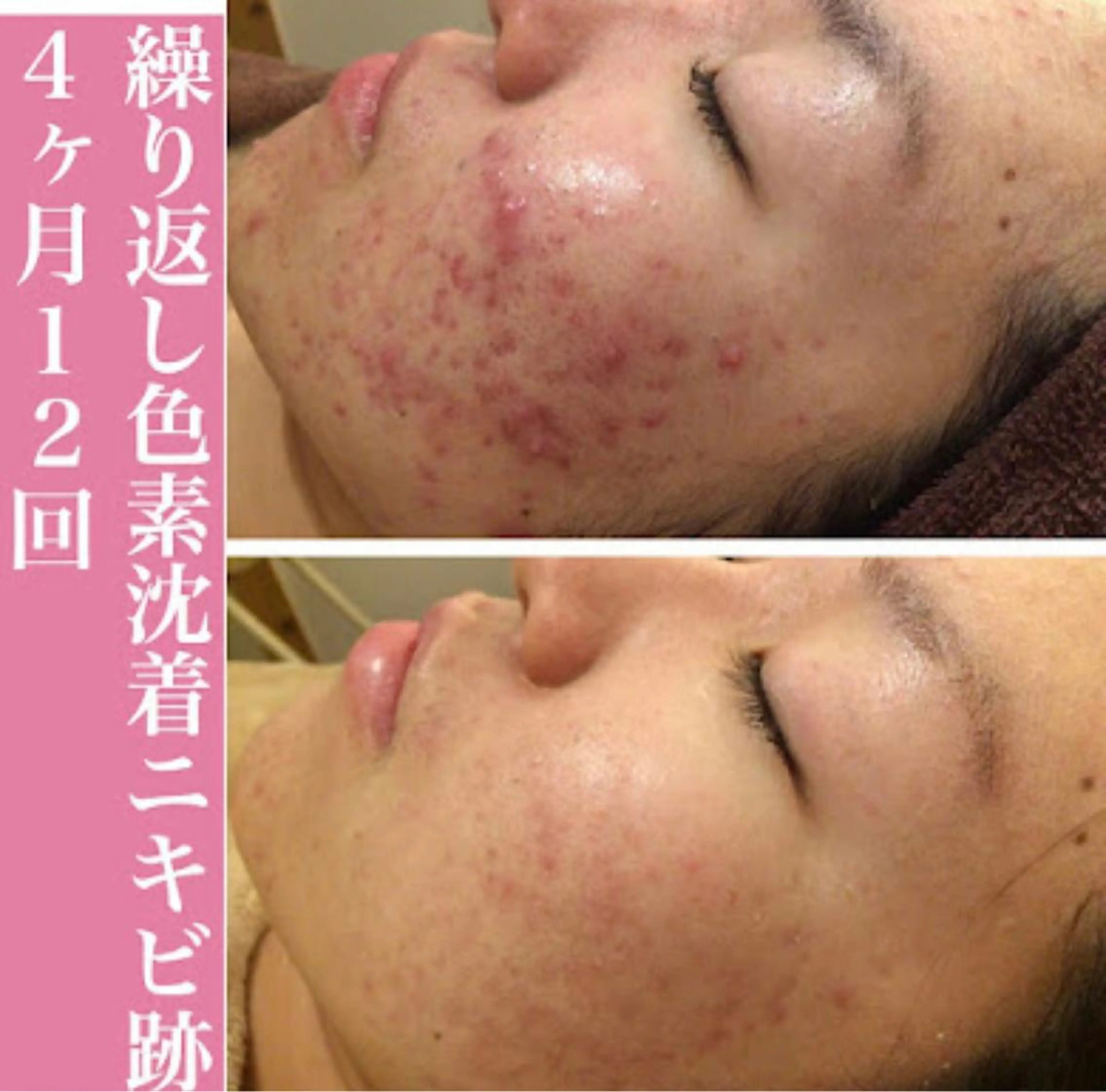 ロング カラー パーマ ヘアアレンジ メンズ ネイル マツエク・マツパ 都内で出来る肌管理！ 最短ニキビ改善のエステ・リラクイメージ