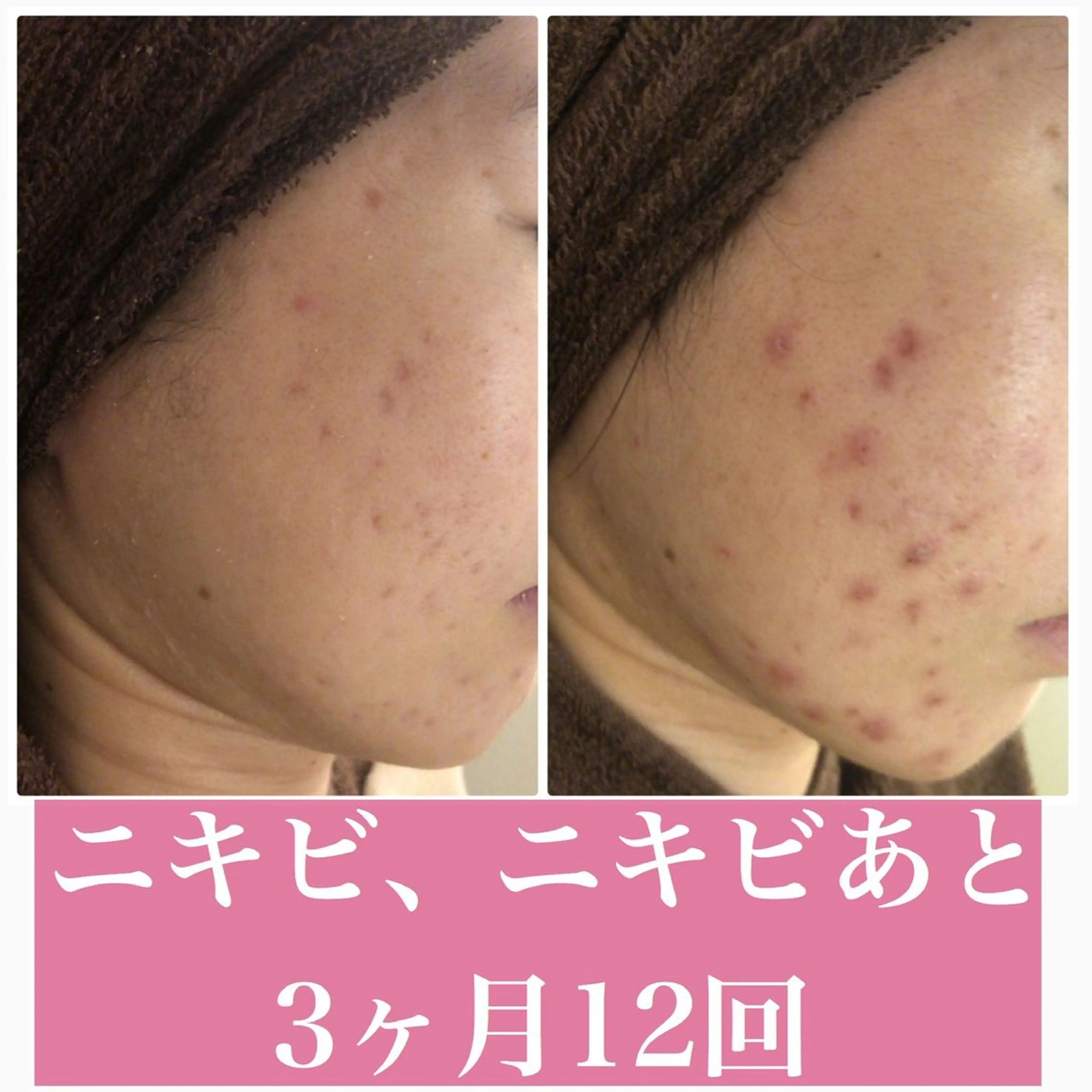 エステ リラク ニキビ跡改善専門🔥 医療にはできない改善のエステ・リラクイメージ