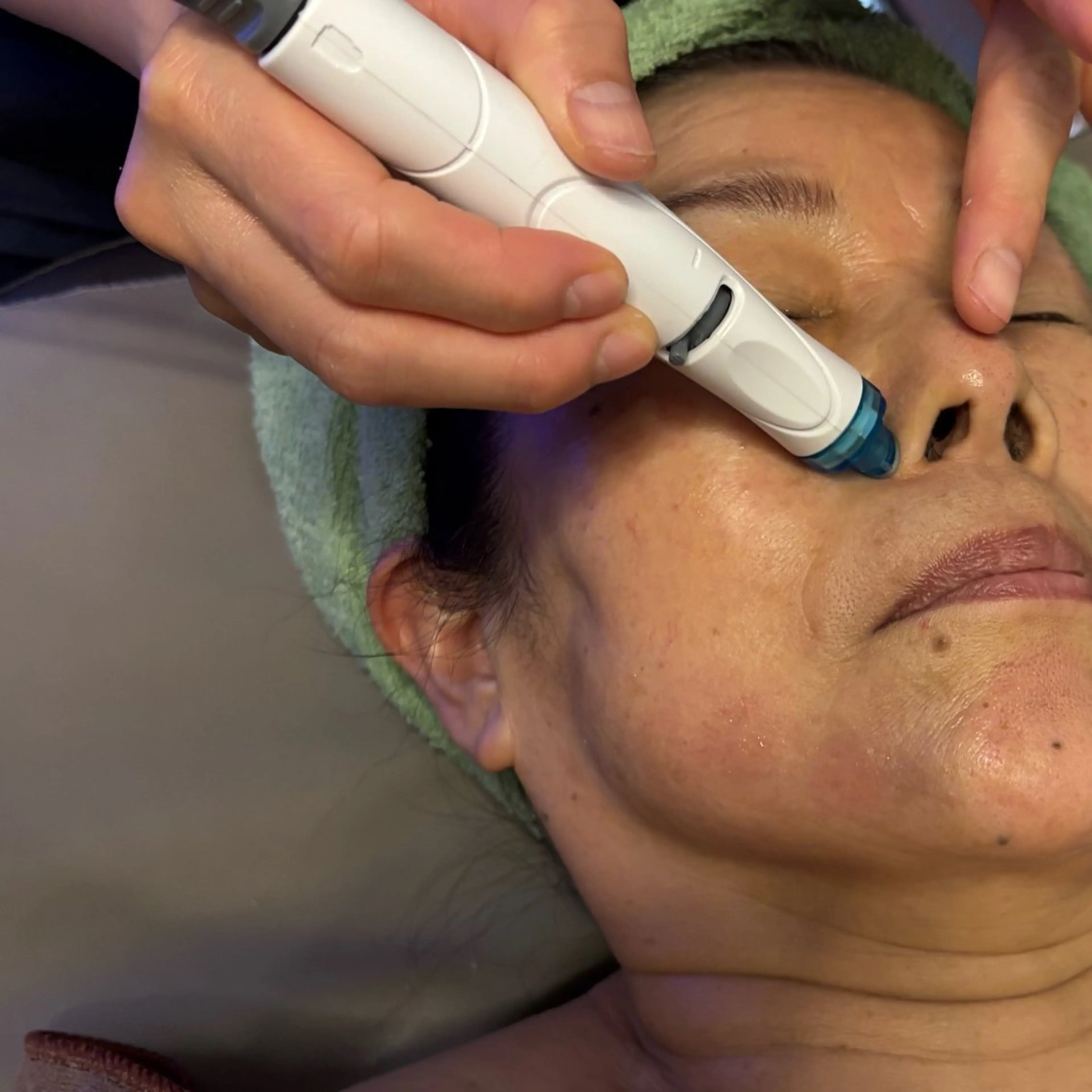 メディアクア　ウォーターピーリングの写真