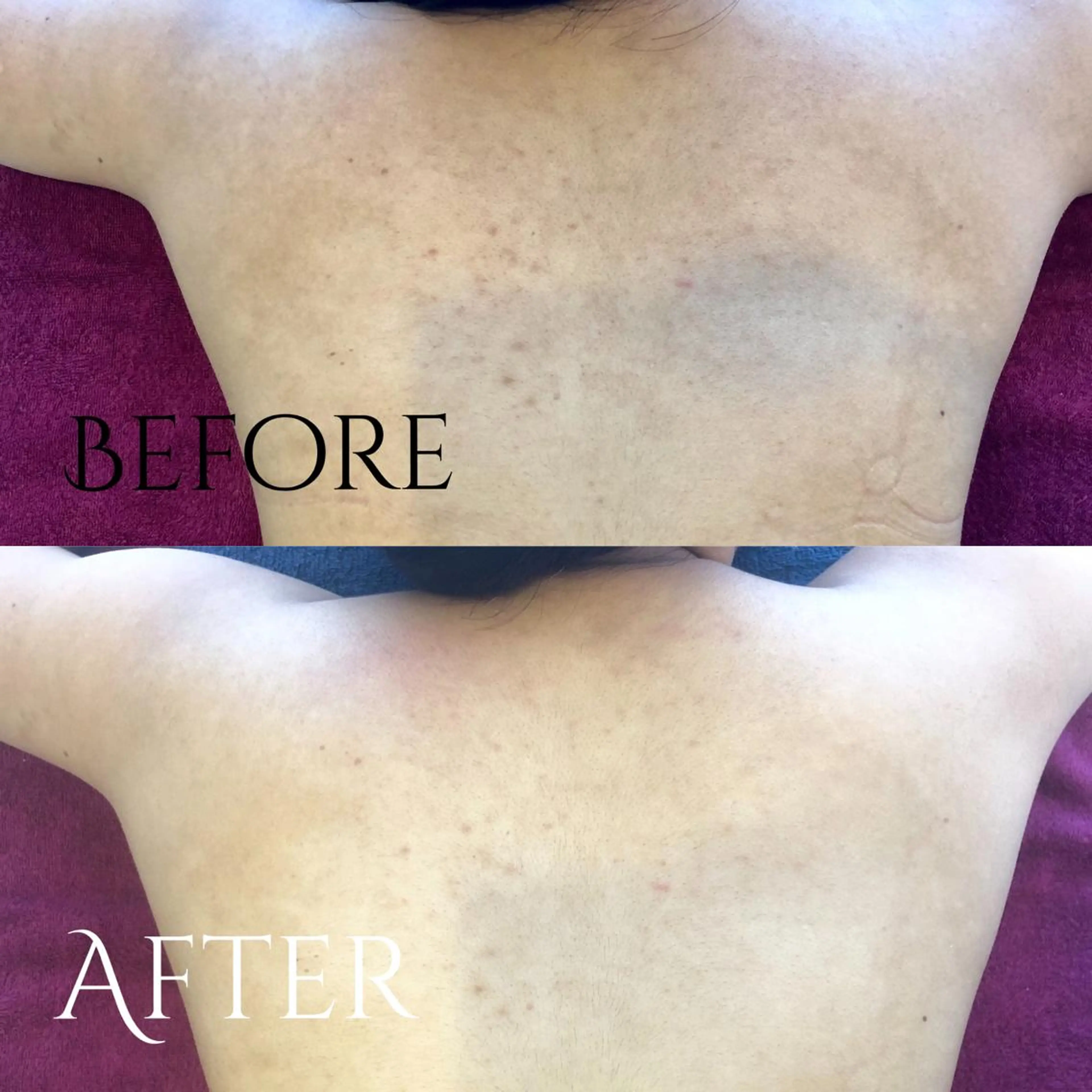 背中ニキビ・黒ずみケアコース(他部位も可能)の写真