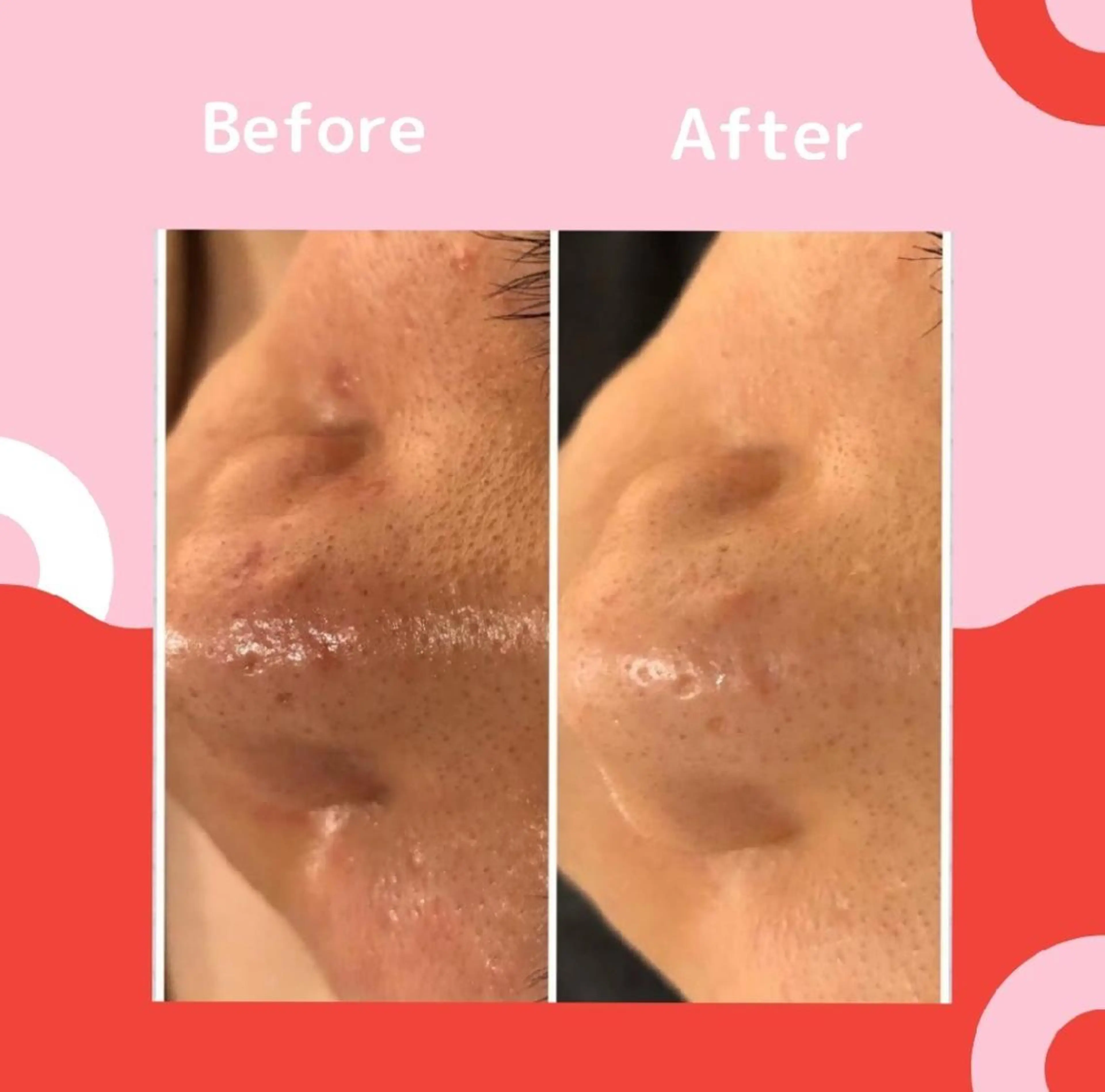 ニキビ跡改善専門🔥 医療にはできない改善のエステ・リラクイメージ