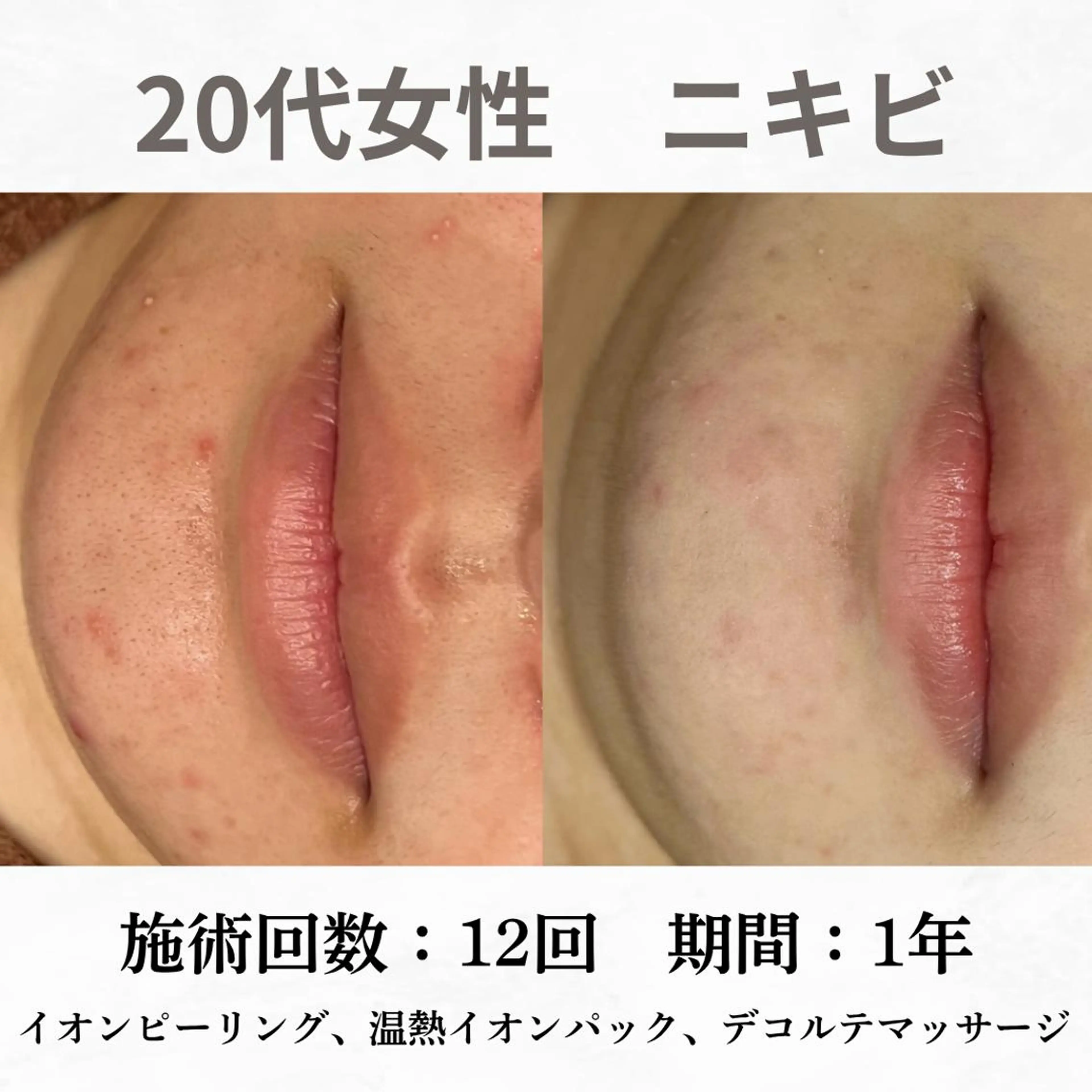 重度ニキビ専門🌷 ダウンタイムなしのエステ・リラクイメージ