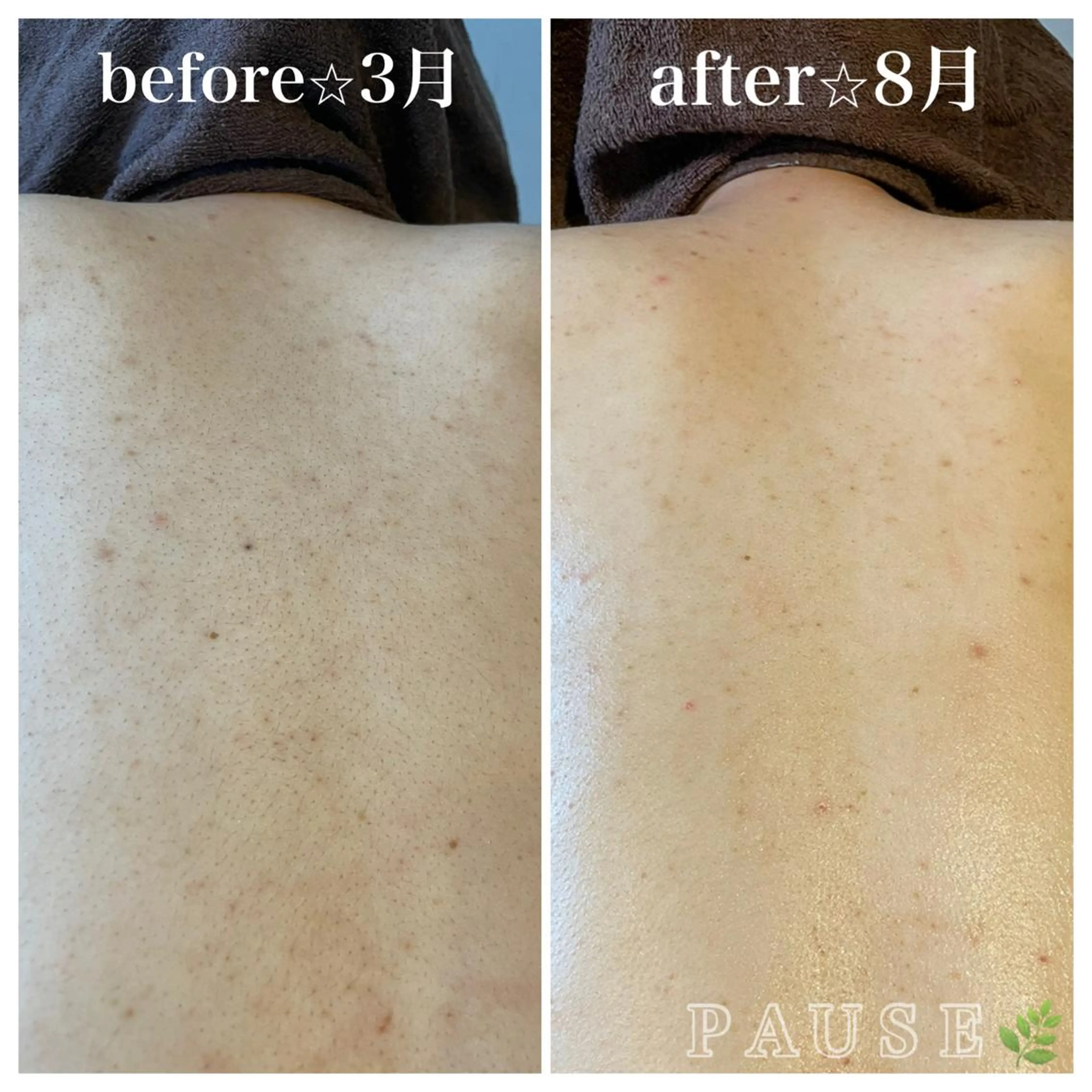 💠背中ニキビ💠なめらかツルツル背中になれる♡60分コースの写真