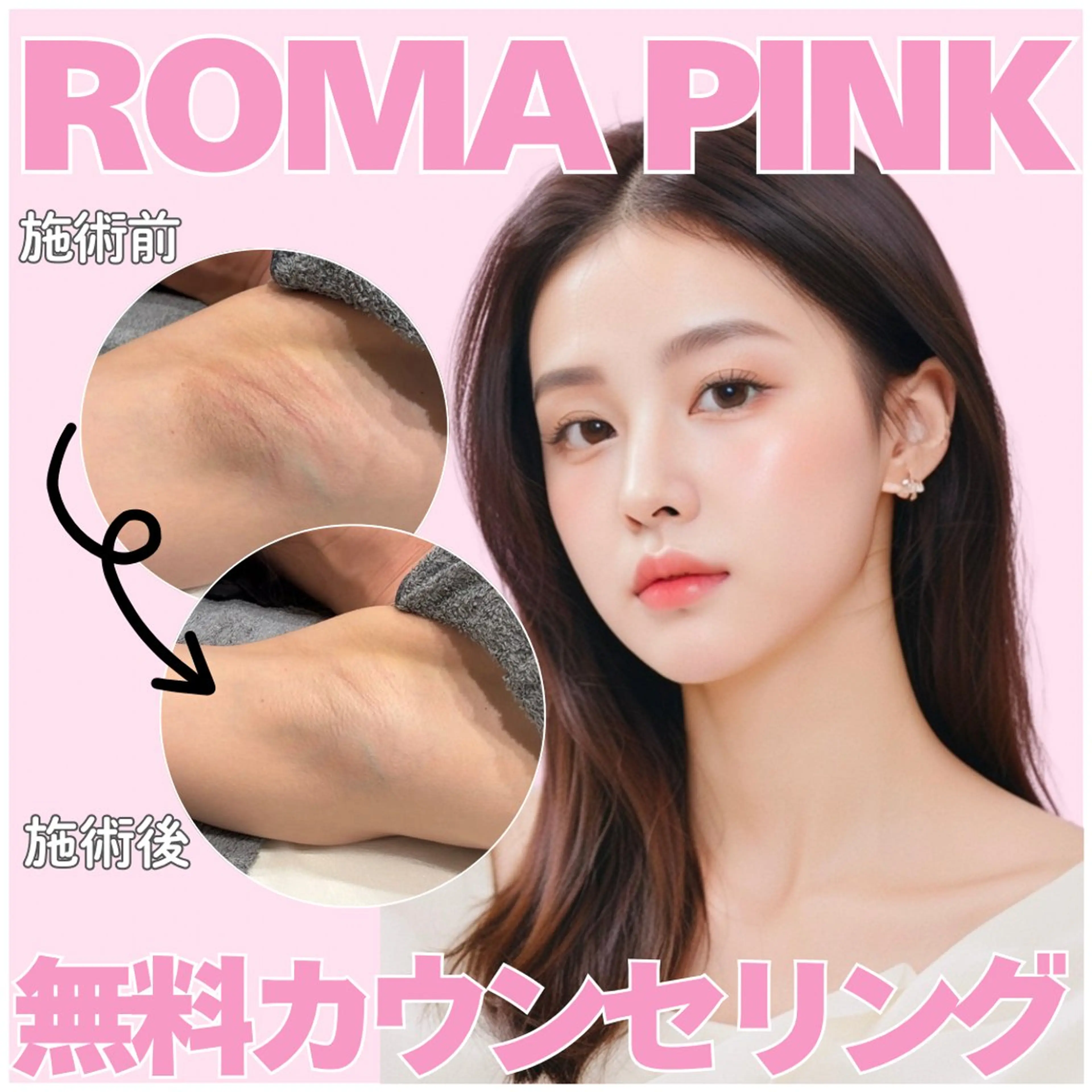 色素沈着・メラニン除去🫧ローマピンク40%OFF【カウセリング相談30分】の写真