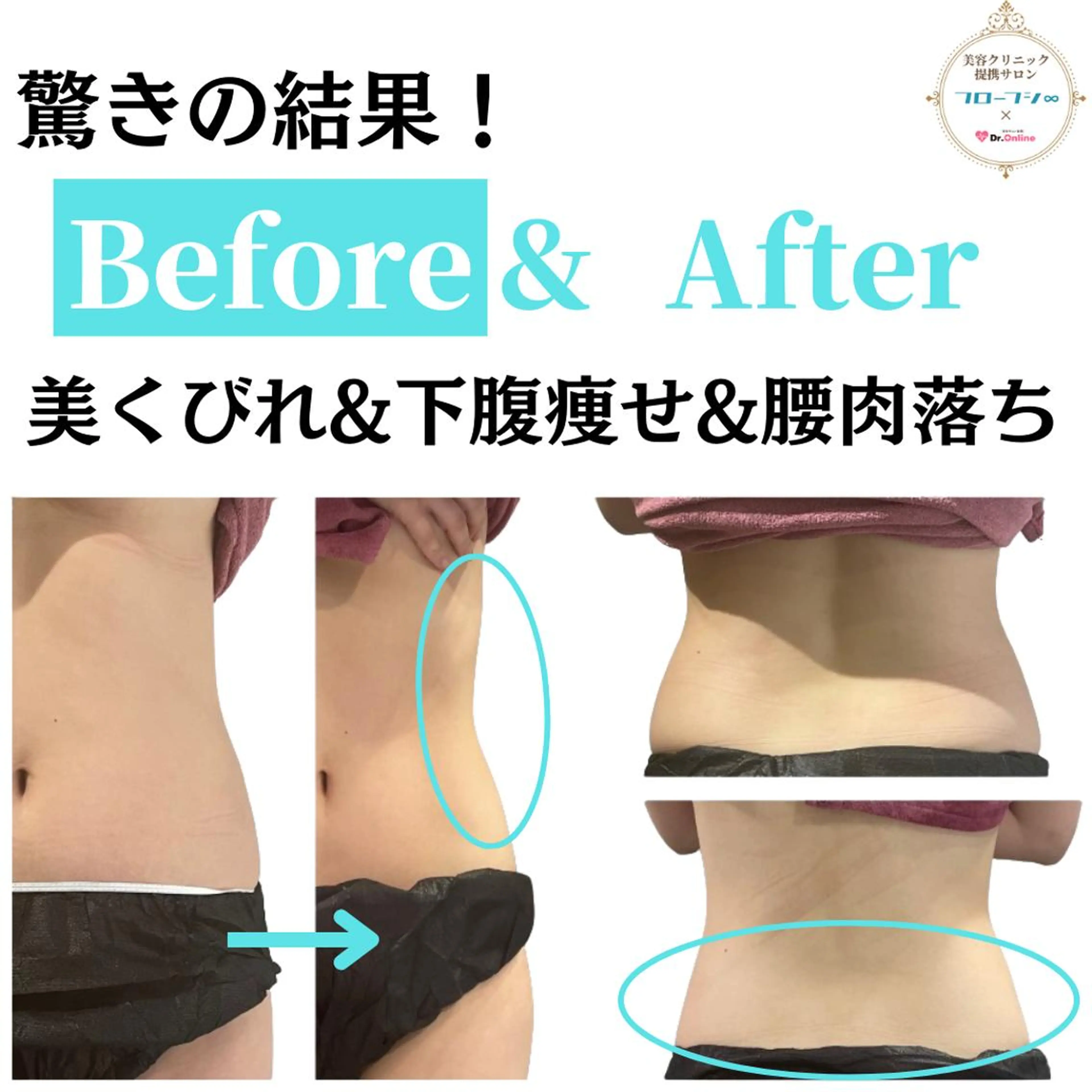 【お腹のぜい肉撃退☆-3cm美くびれ】LD×キャビ×ラジオ波×バキューム×EMSの写真