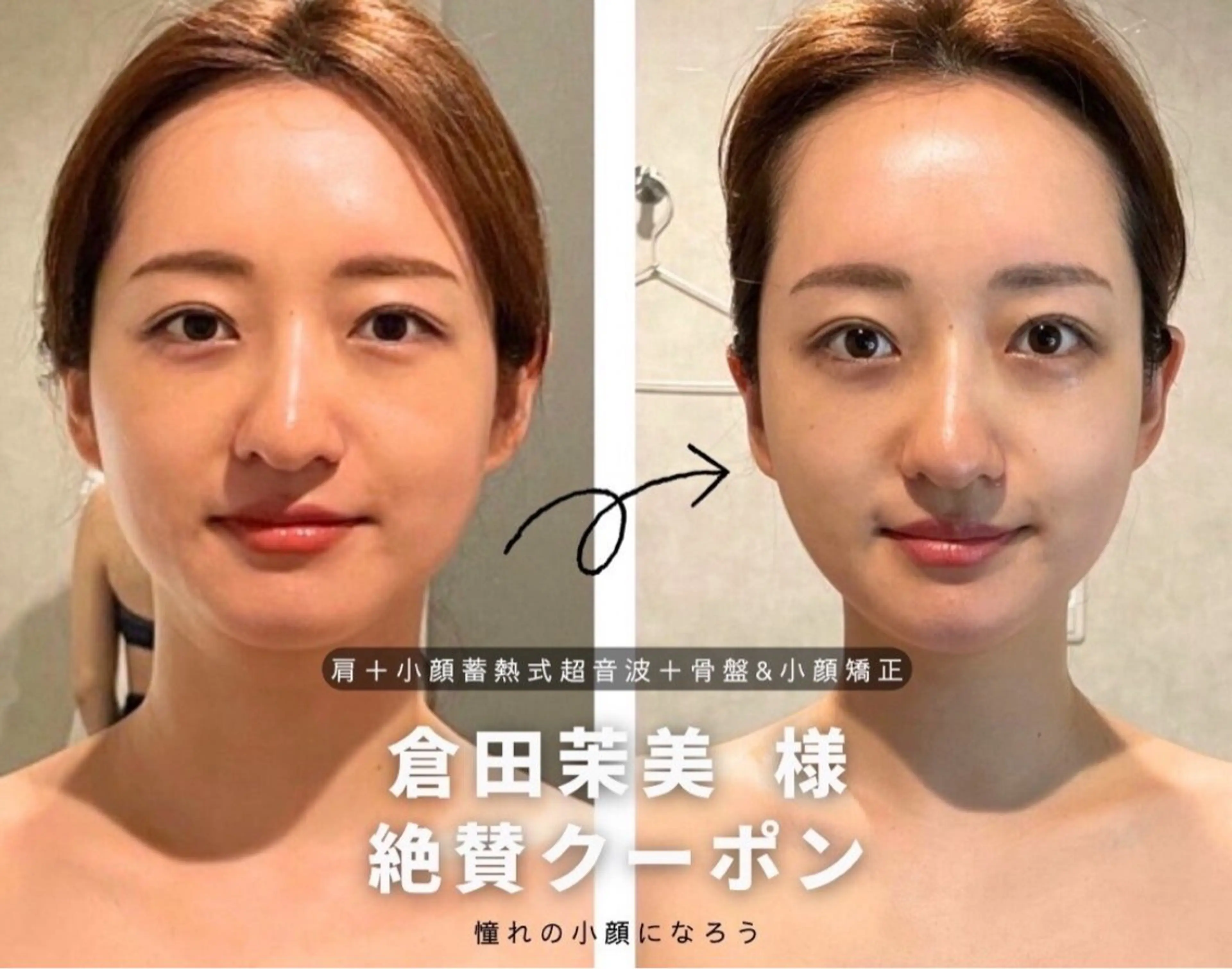 《人気NO.2》小顔&首・肩の張りと疲労を解消！顔の浮腫み・脂肪&たるみ改善の写真