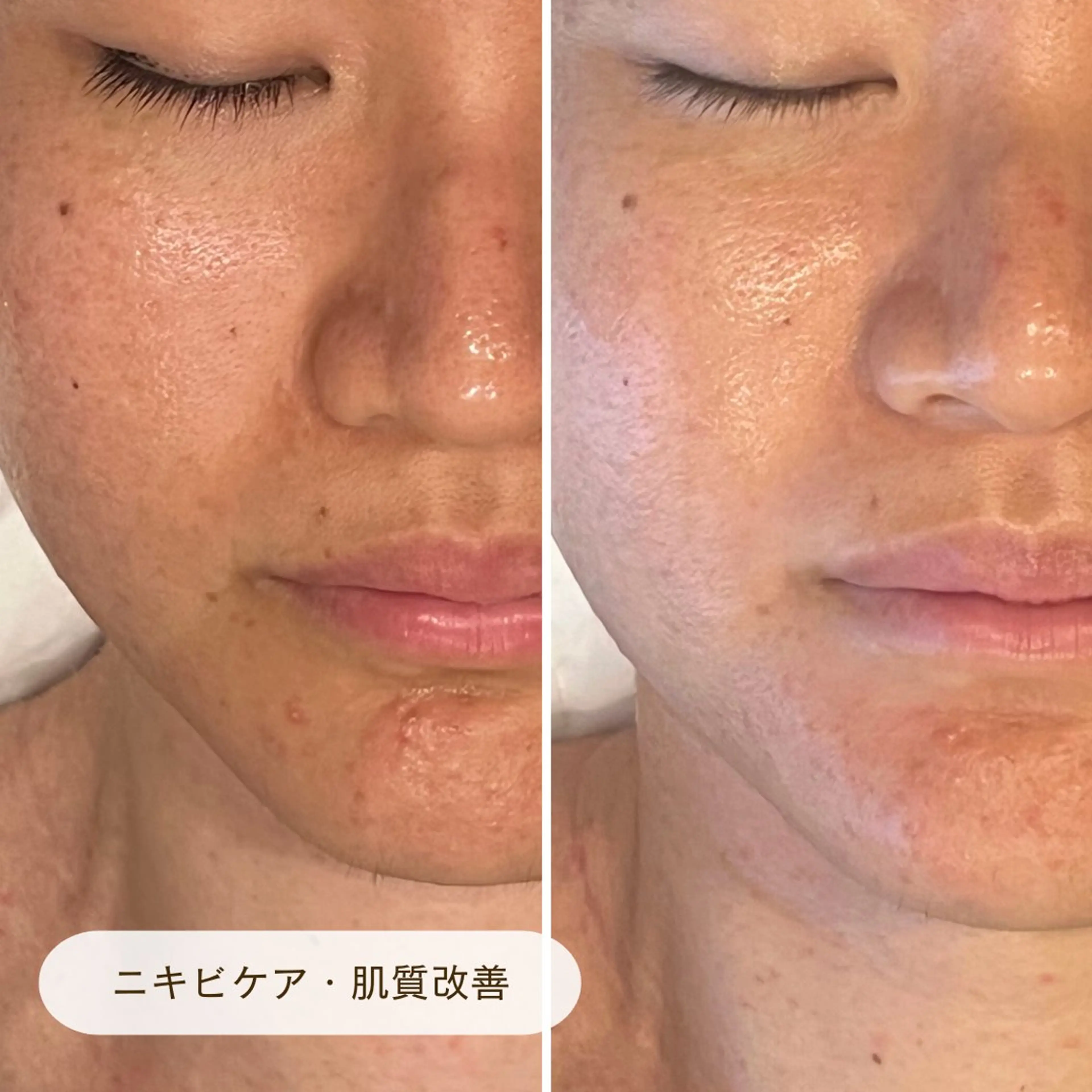 【平日予約限定価格】肌質改善ニキビ・ニキビ跡・肌荒れ*プラズマの殺菌・ピーリング・肌再生促進効果でトラブル知らずな肌へ！の写真