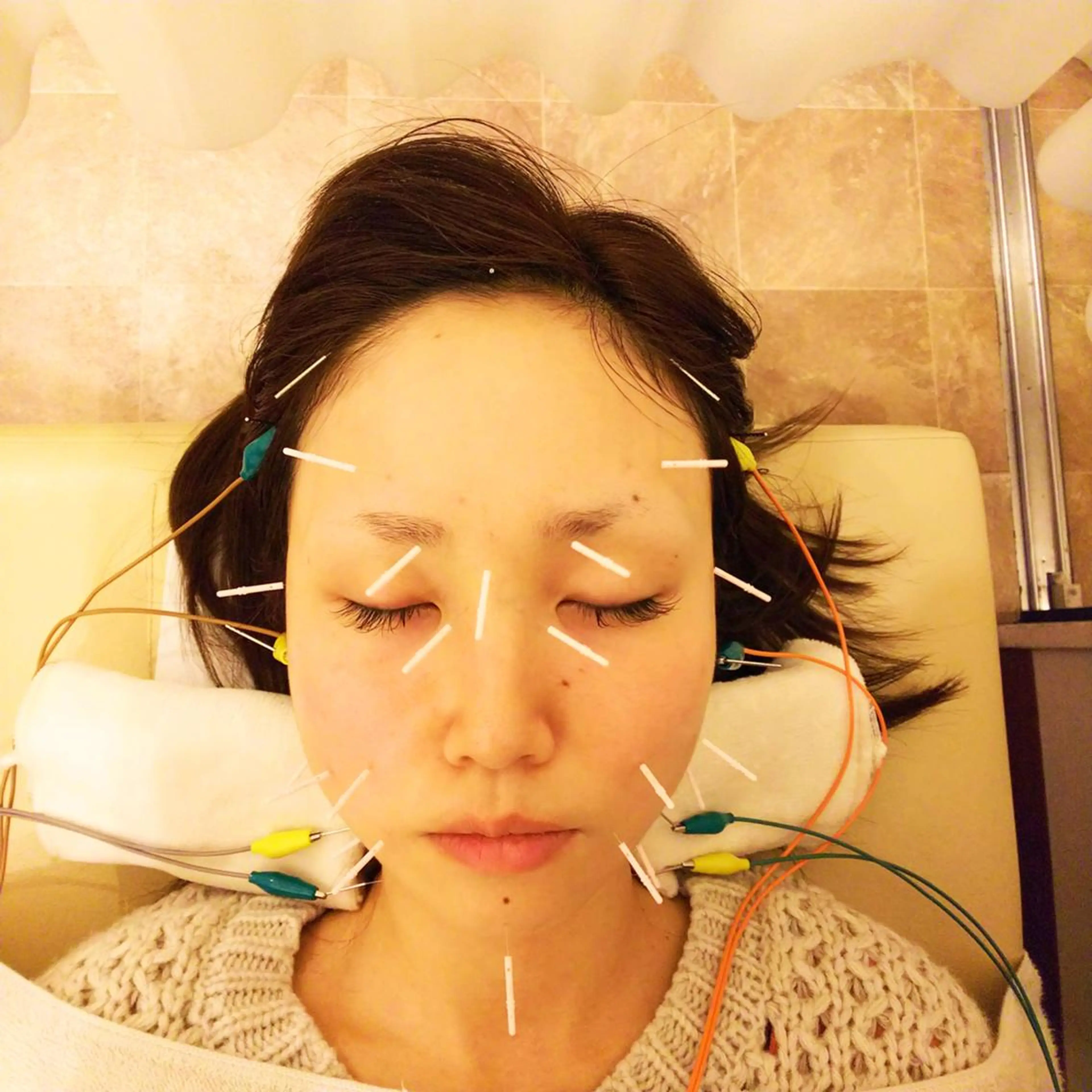 ✨小顔美容鍼(首・あご・顔・頭)🚩75分9900円→6600円の写真