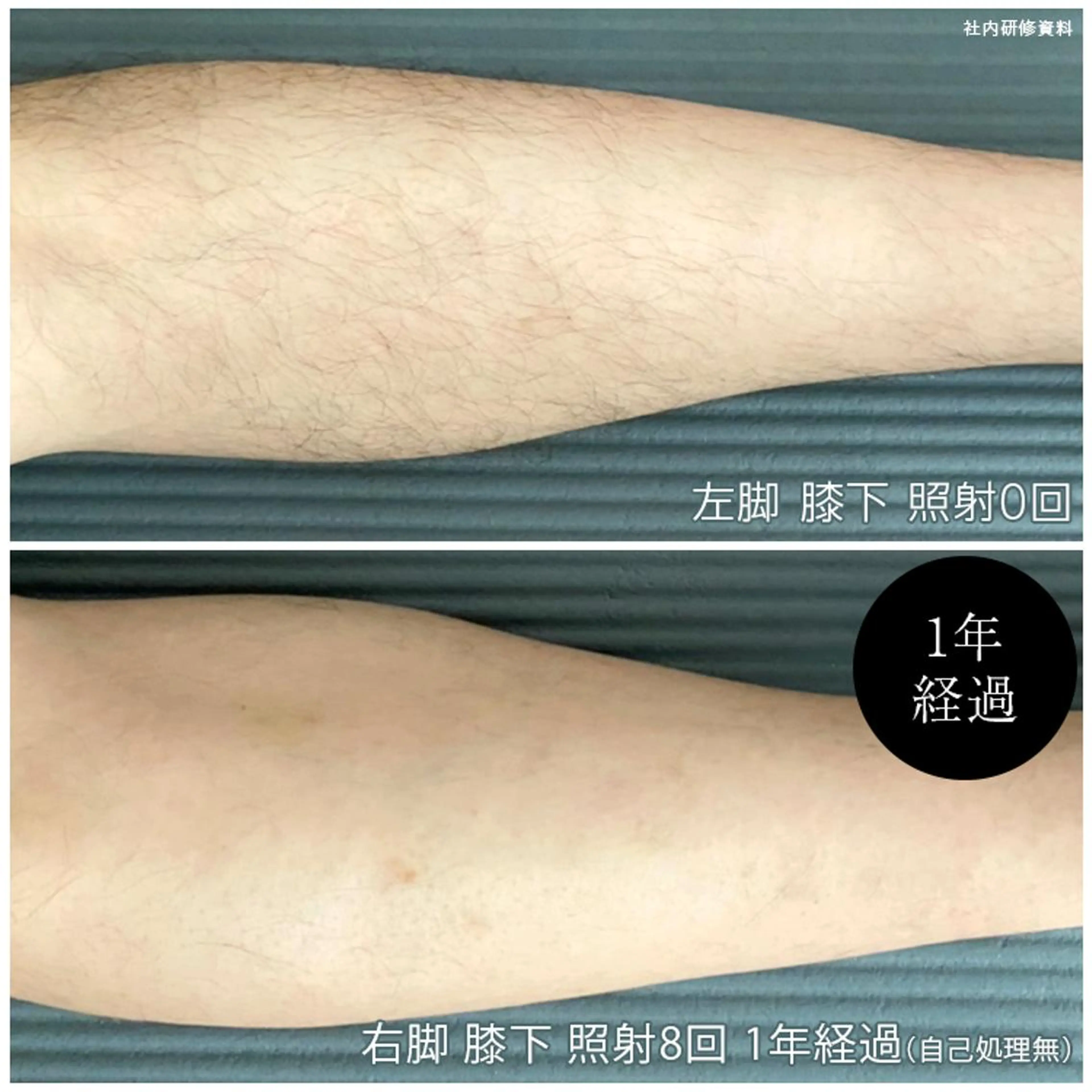 オシャレメンズの定番【メンズ両足脱毛】国産マシンで安心安全に痛みなく少ない回数で清潔な足元に！の写真