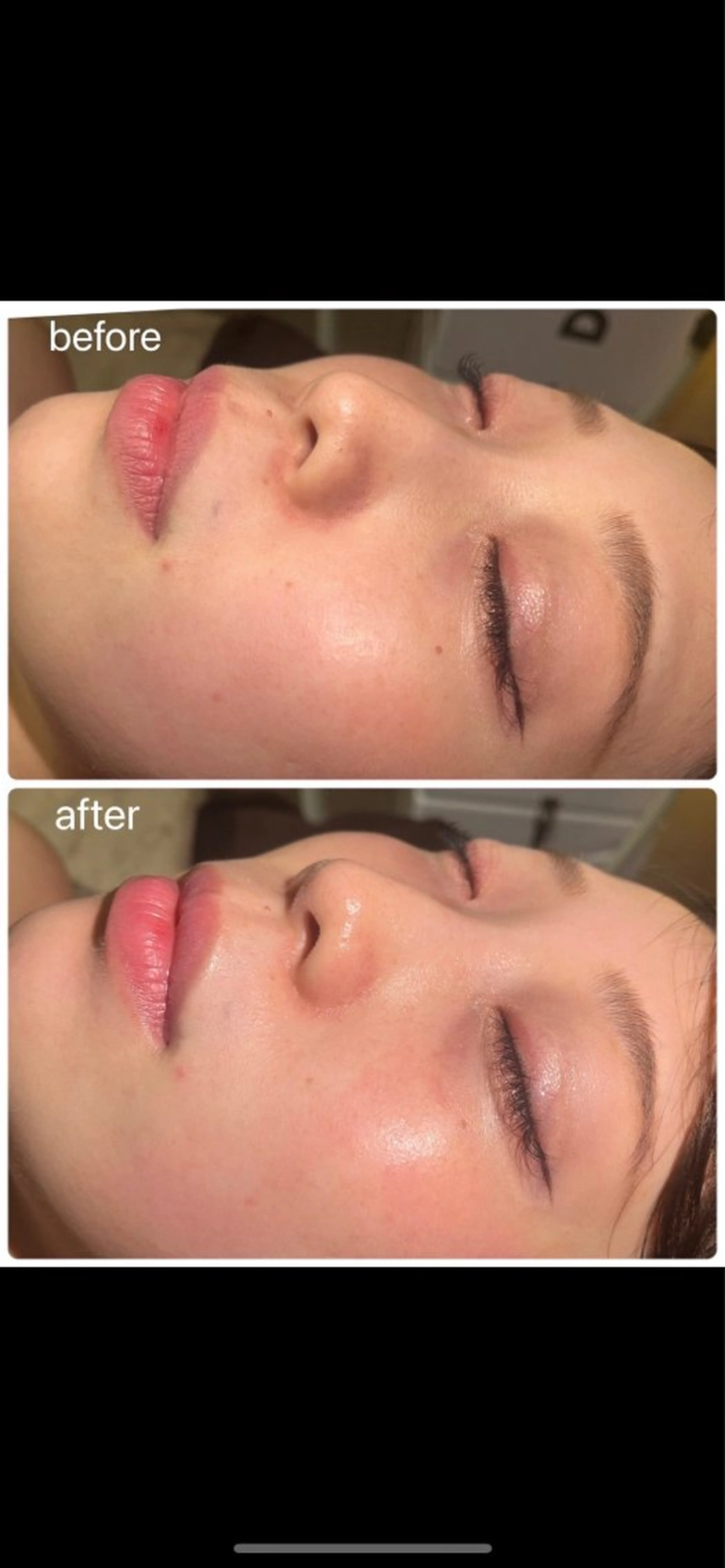 エステ 青山・表参道/ 💎肌質改善/inoのその他イメージ