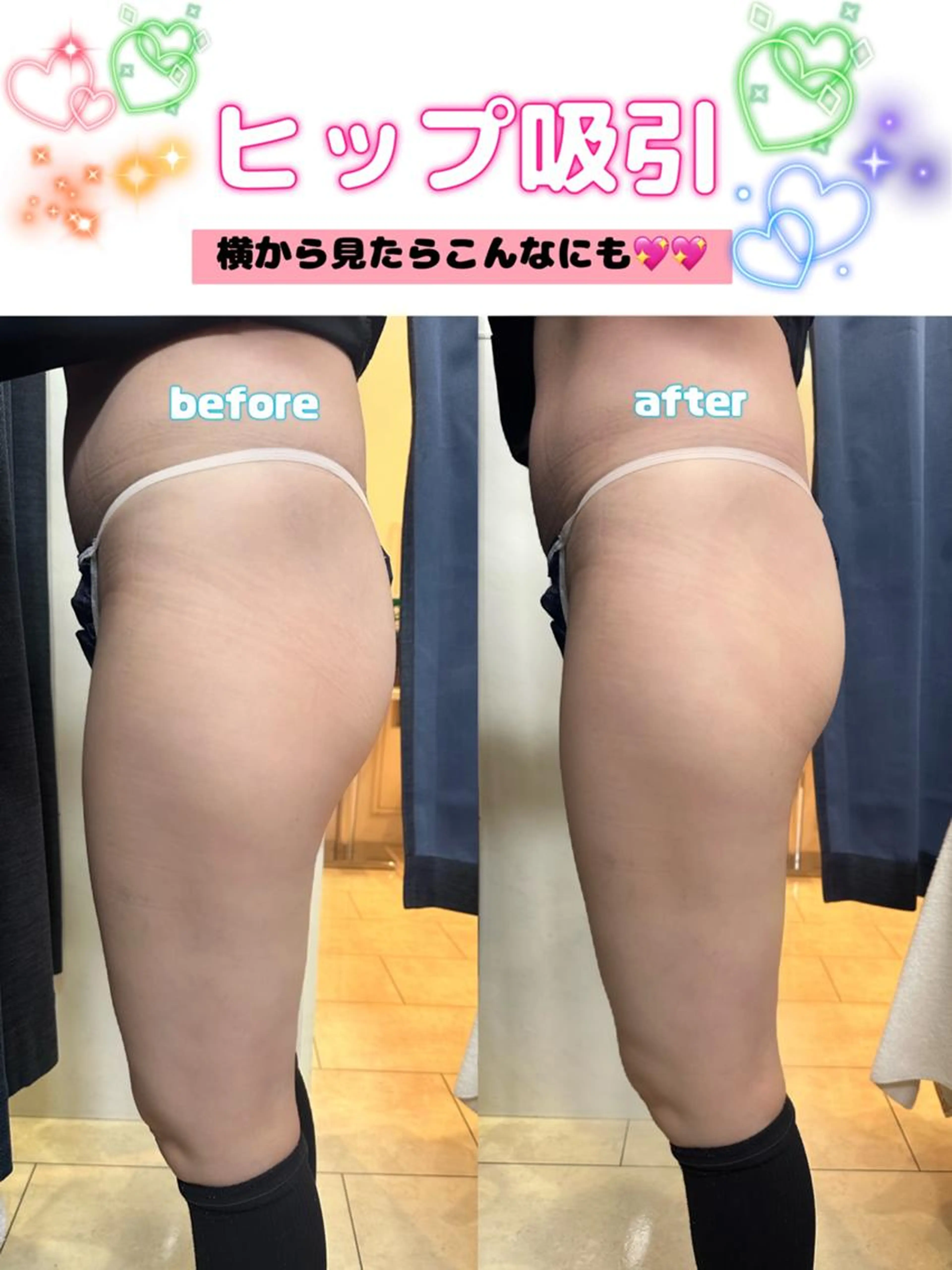 【✨🎁minimo限定キャンペーン！🎁✨】ヒップベーシックコース😀￥4,400～の写真