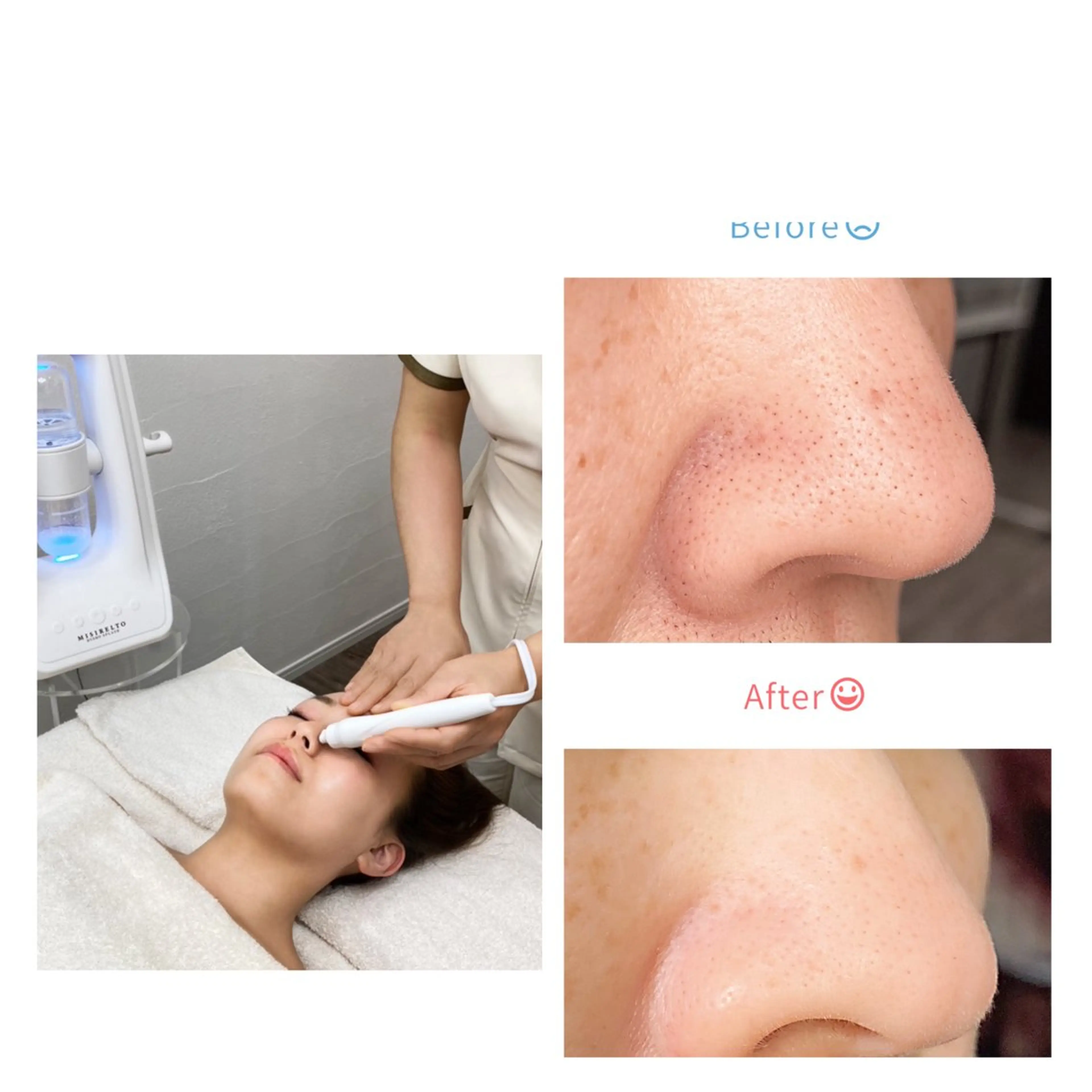 毛穴洗浄！ホームケアで取れない頑固な小鼻の汚れを水素水で洗うのでお肌に負担ゼロ¥7.500の写真