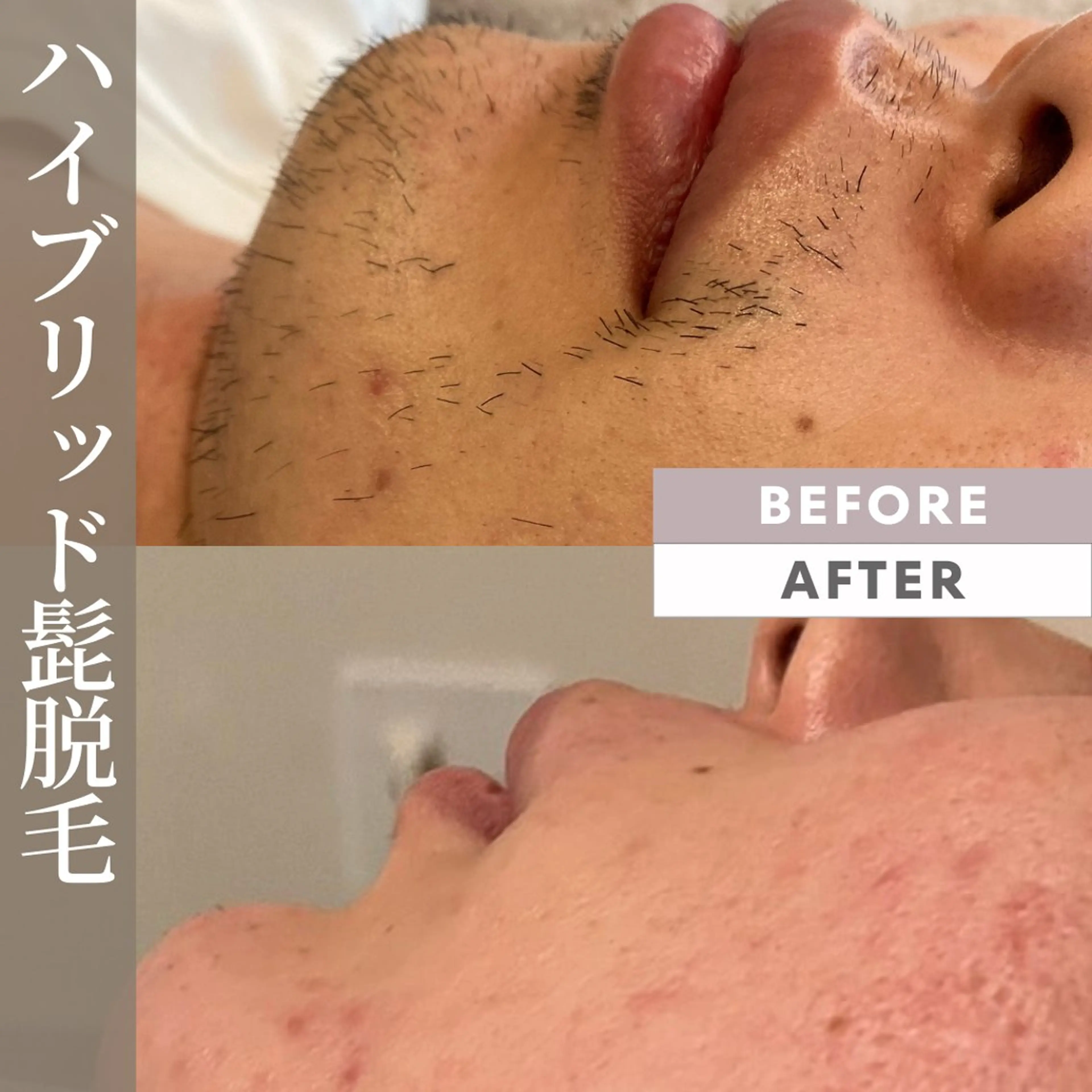 メンズ髭ハイブリッド脱毛🥸の写真