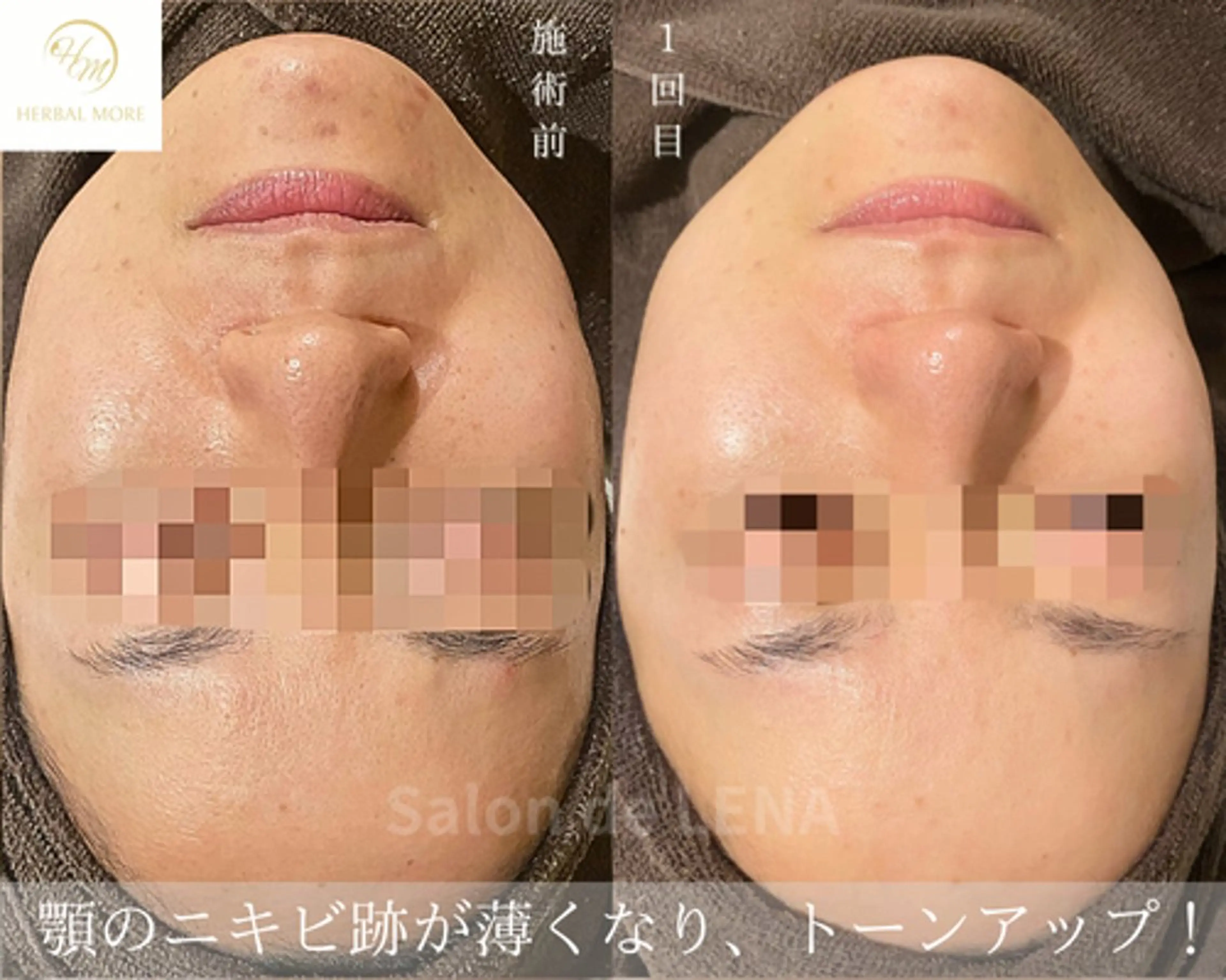 エステ サロンドレナ名駅店所属・ハーブピーリング専門 サロンドレナ平岡のエステ・リラクイメージ