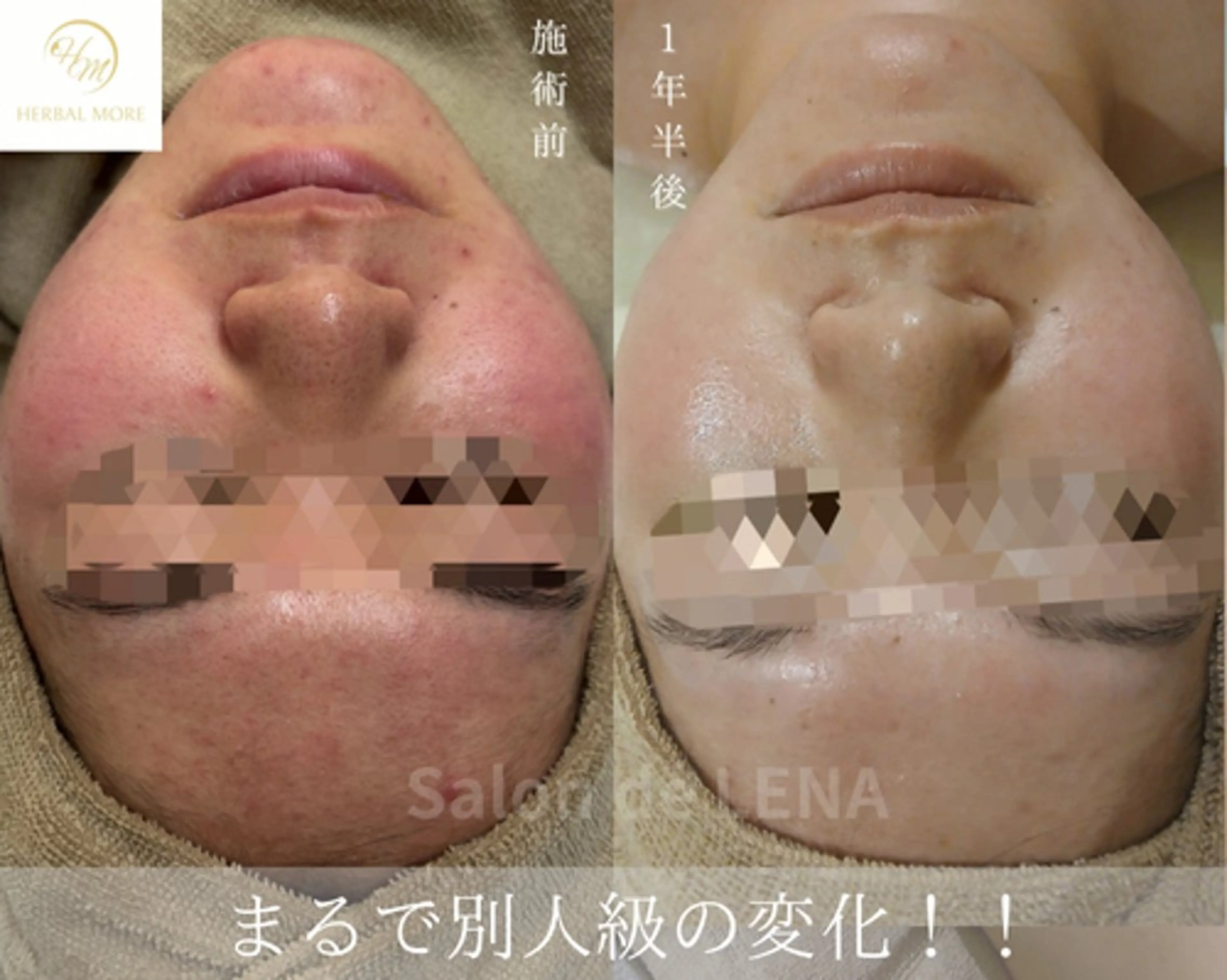 《顔◆最強ニキビケア》ハーブピーリング×アクネ菌ケア×鎮静×毛穴洗浄の写真