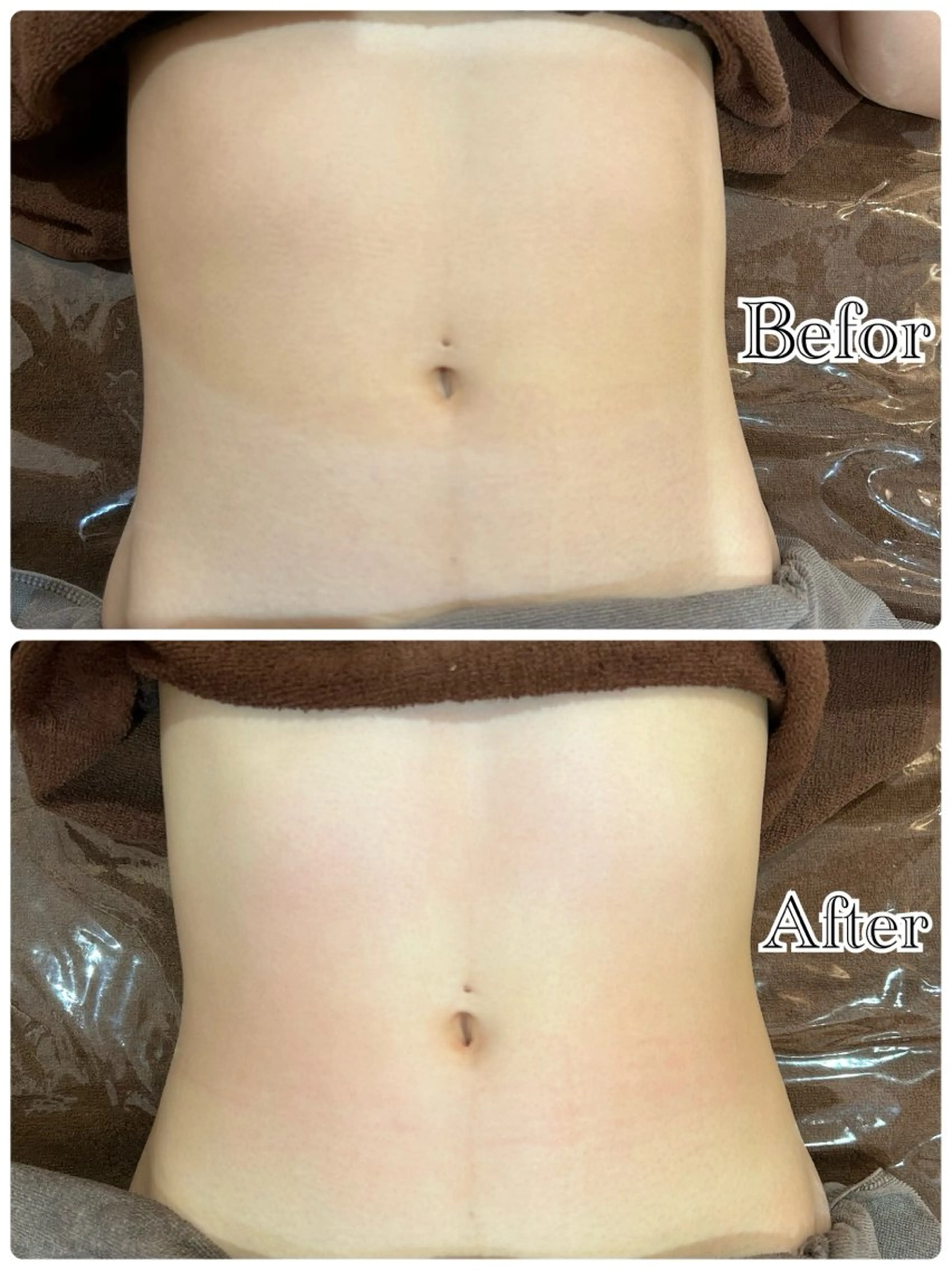 【痩身/上半身痩せくびれ】美骨盤矯正+ハイパーナイフ+電磁パルス75分の写真