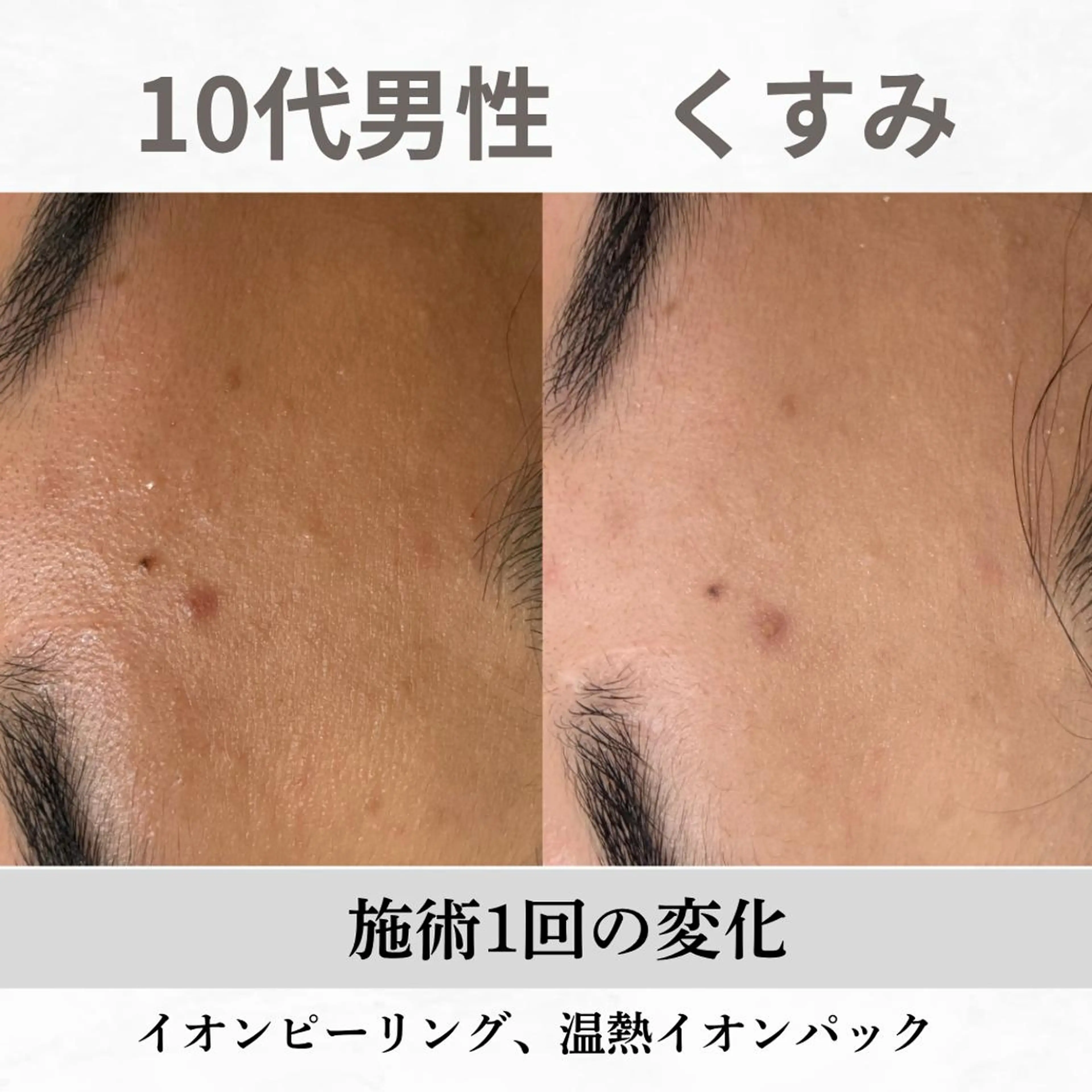 重度ニキビ専門🌷 ダウンタイムなしのエステ・リラクイメージ