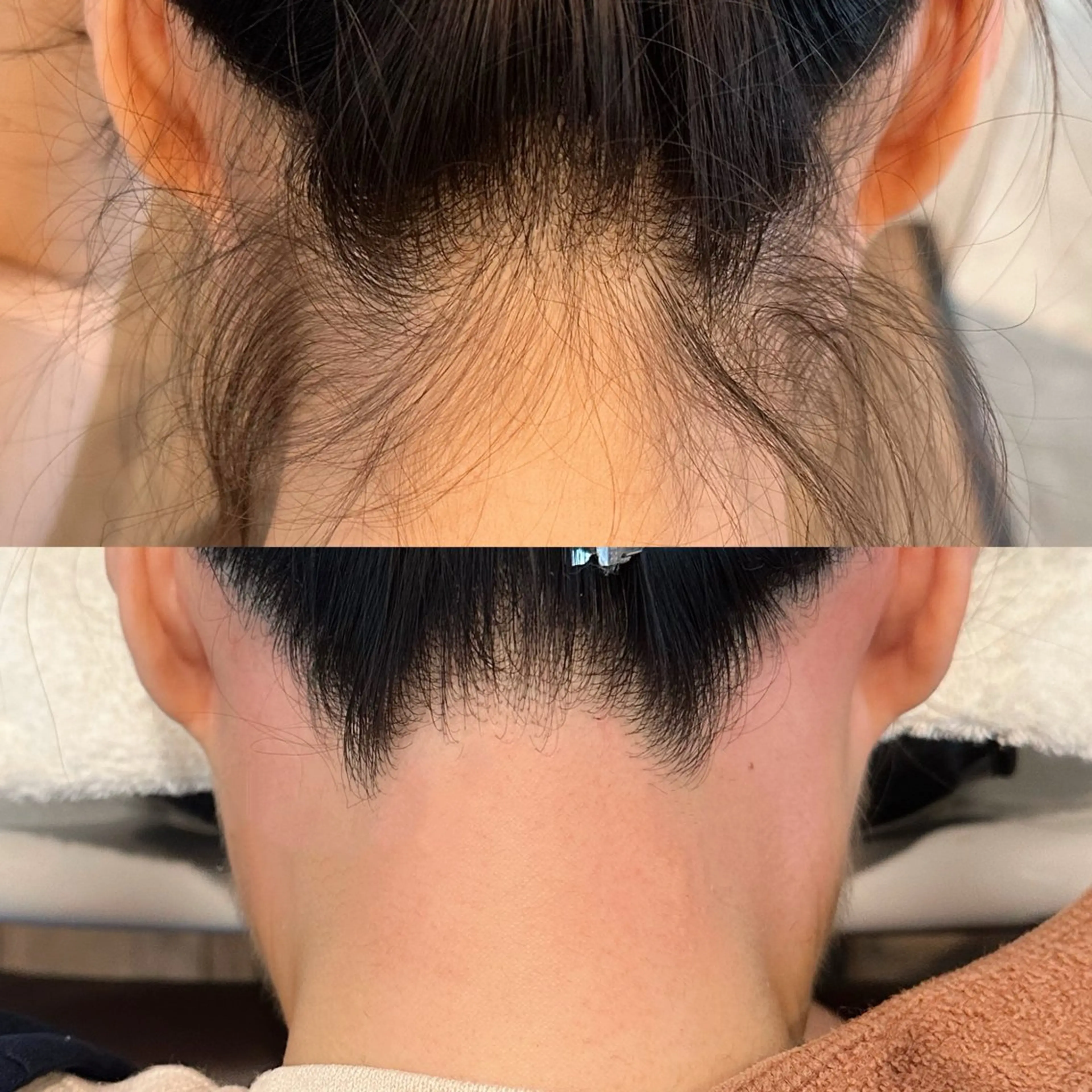 うなじワックス脱毛の写真