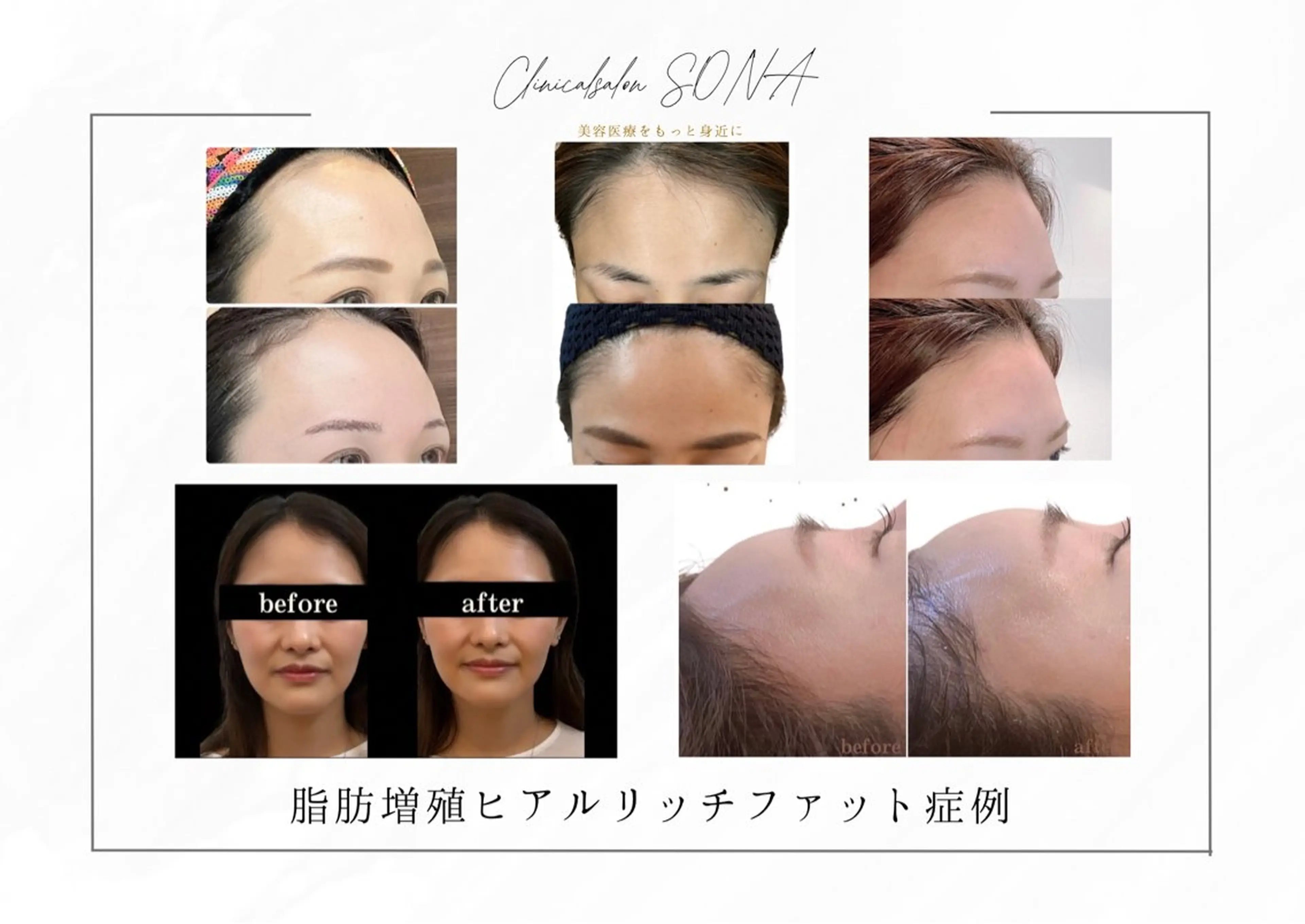 小顔/たるみ/黒ずみ除去専門サロン/SONA 大和西大寺店所属・【小顔専門看護師 サロンSONA】のエステ・リラクイメージ