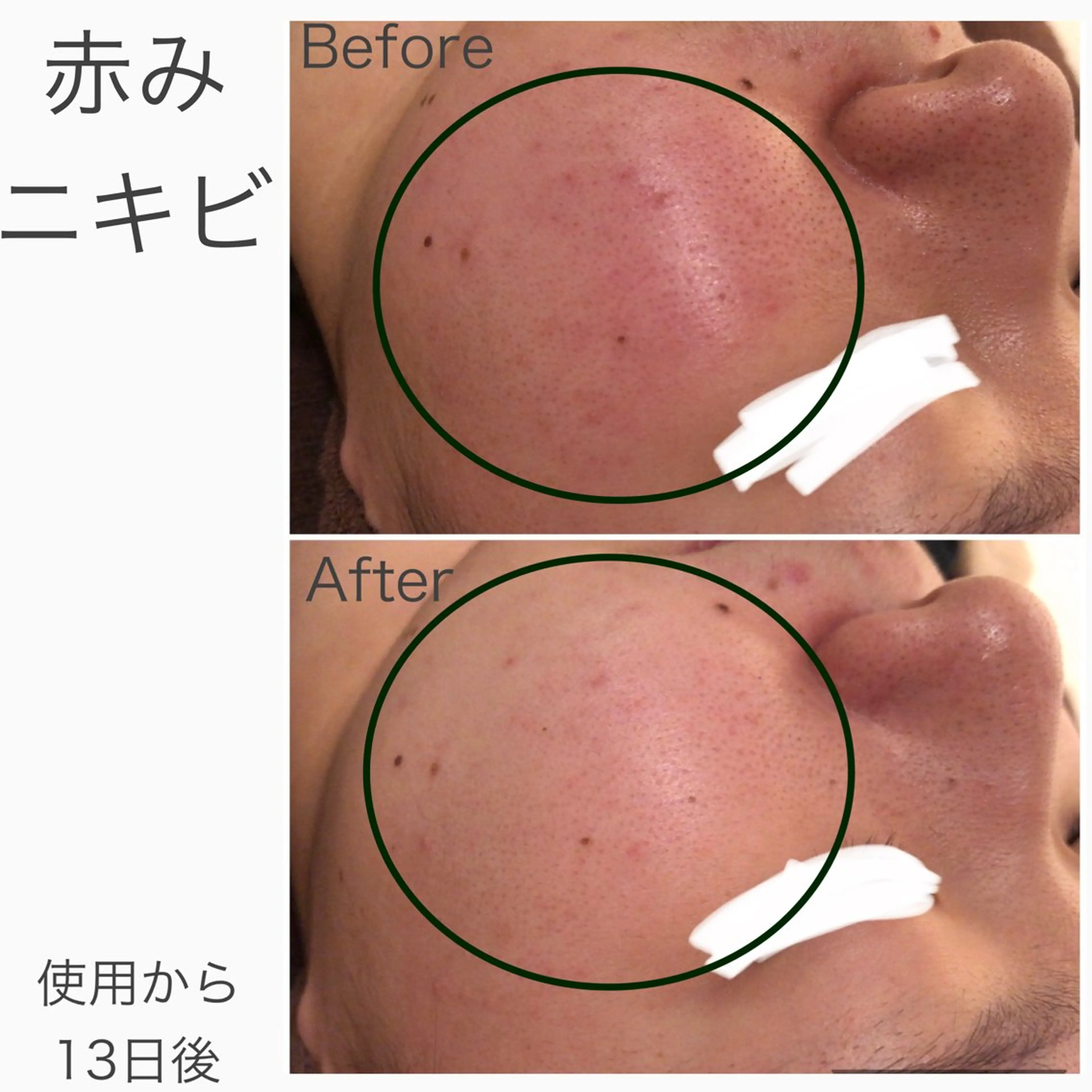 ニキビ跡改善専門🔥 医療にはできない改善のエステ・リラクイメージ