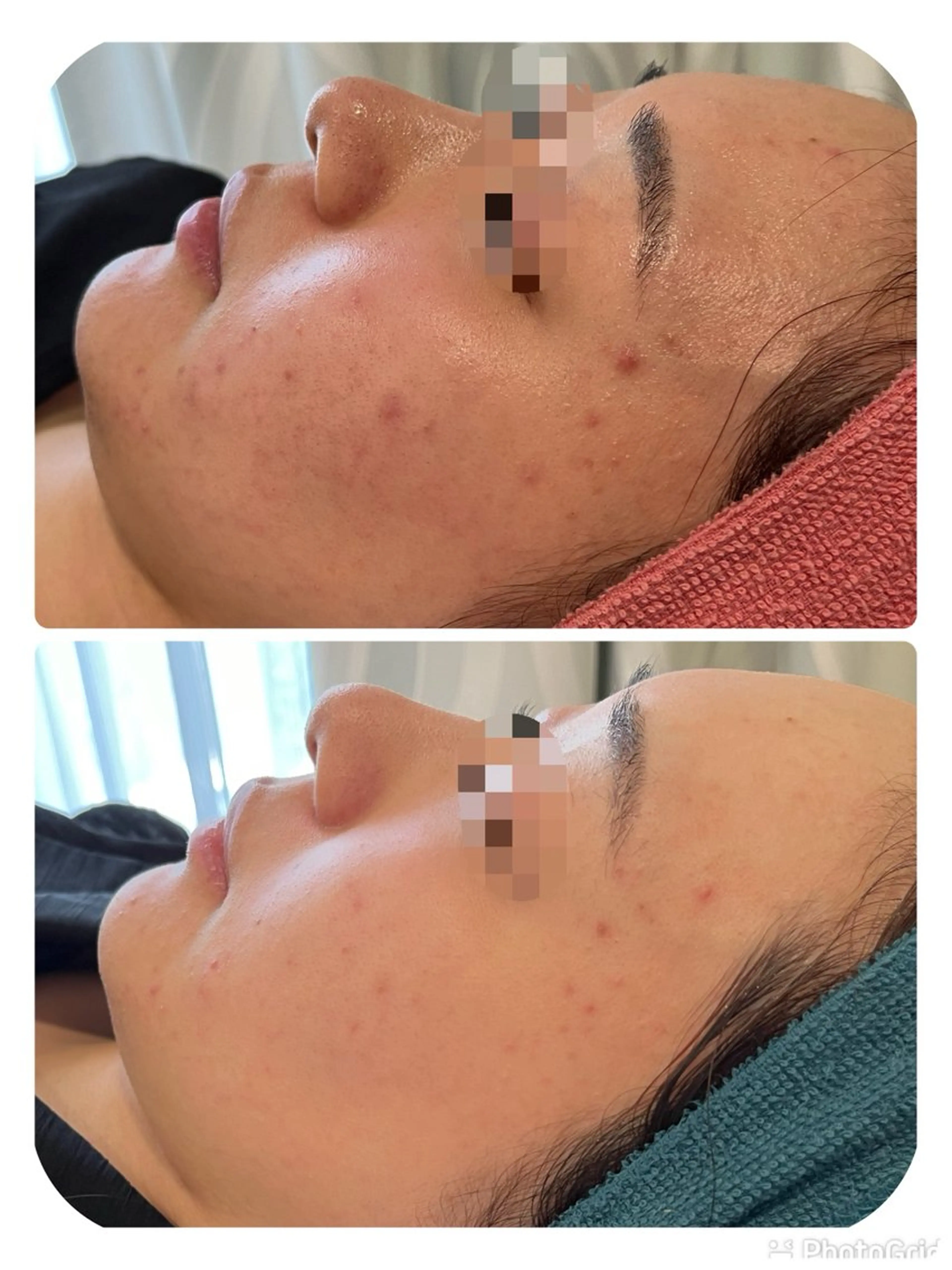 エステ 【リベルハーブピーリング認定店】敏感肌・美白脱毛専門店Dione立川店所属・Dione 立川店のエステ・リラクイメージ