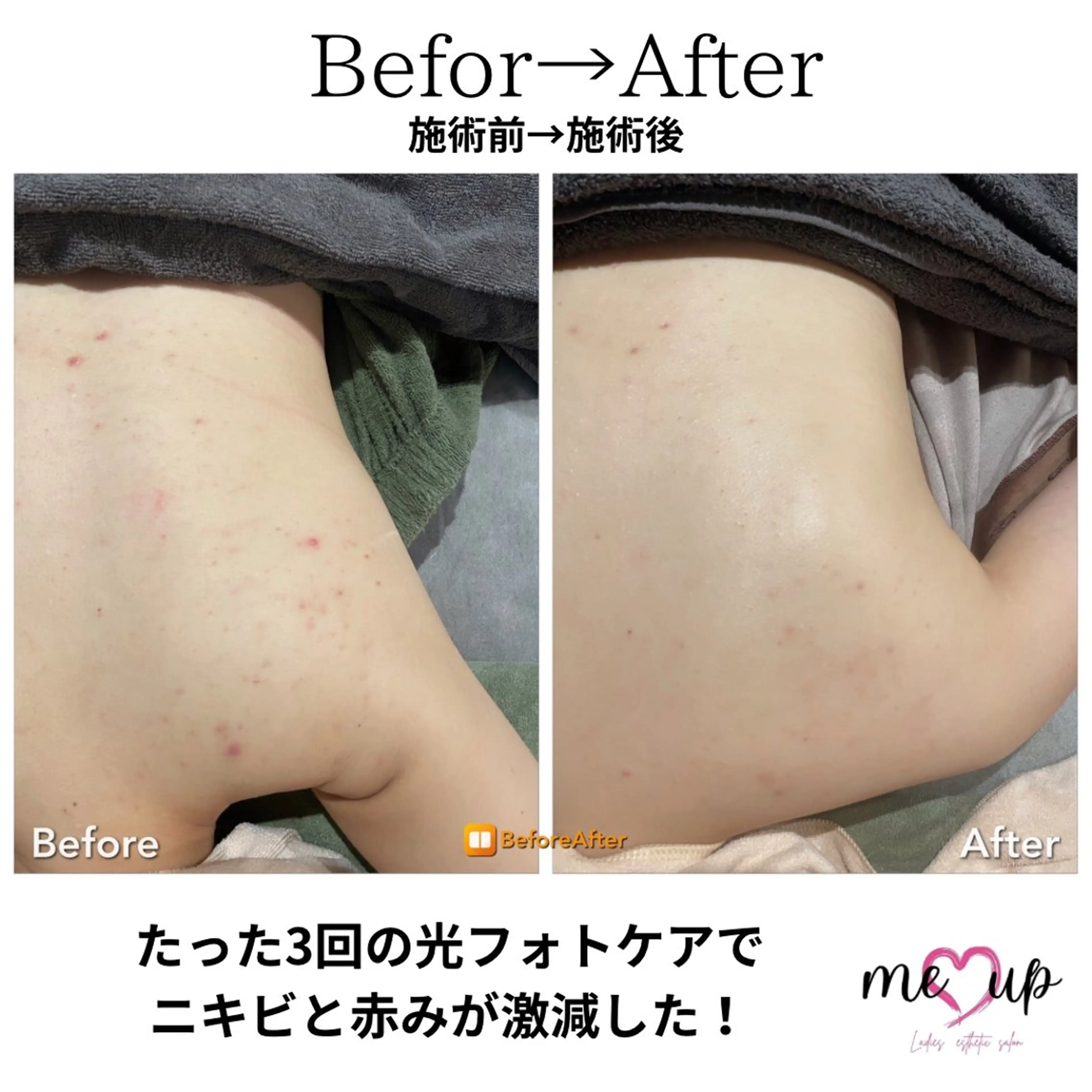 エステ Meupニキビ専門店 背中/ハーブ/肌管理のその他イメージ