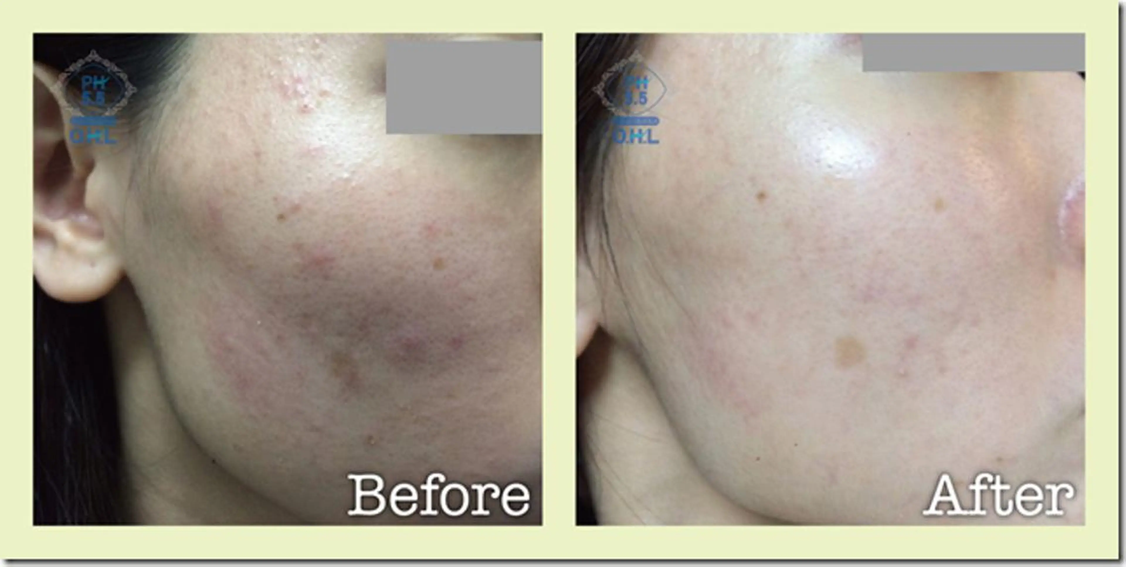 エステ 【リベルハーブピーリング認定店】敏感肌・美白脱毛専門店Dione立川店所属・Dione 立川店のエステ・リラクイメージ