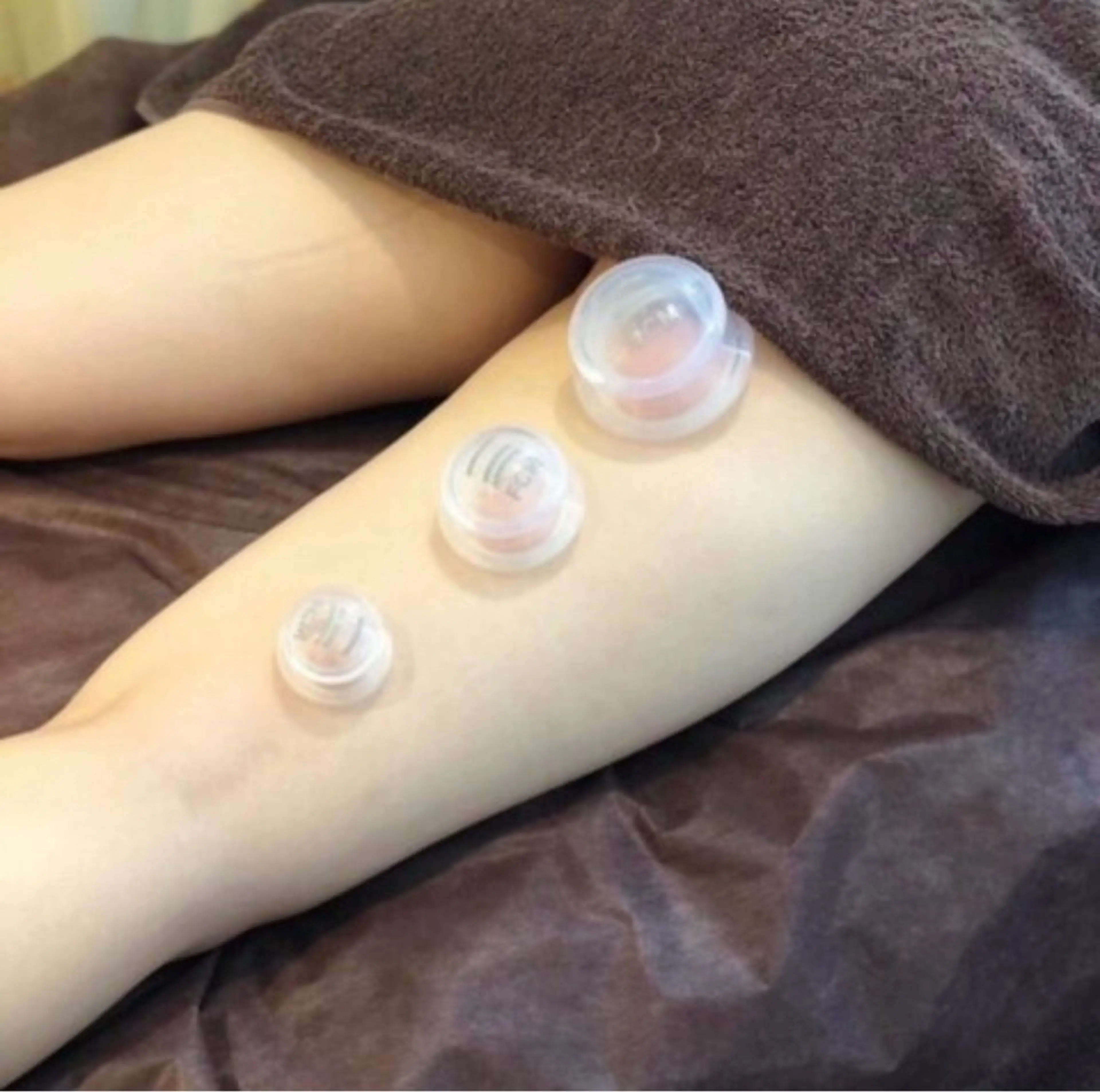 💥カッピング　全身45分💥全身浮腫ケア/筋膜リリースの写真