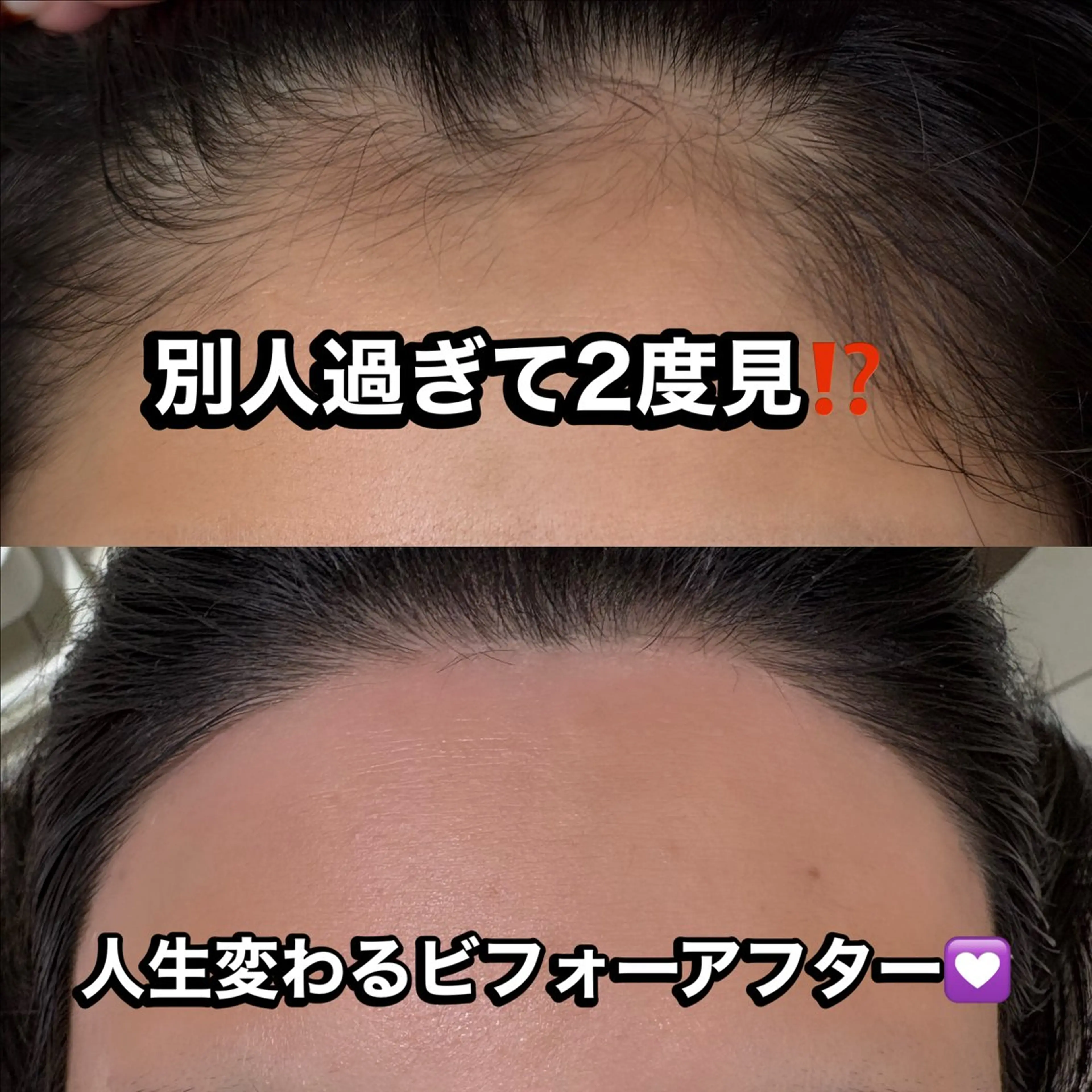 【眉×おでこ】１番人気❤️‍🔥ハリウッドブロウリフト×おでこワックス❤️‍🔥眉毛も！おでこも！の写真