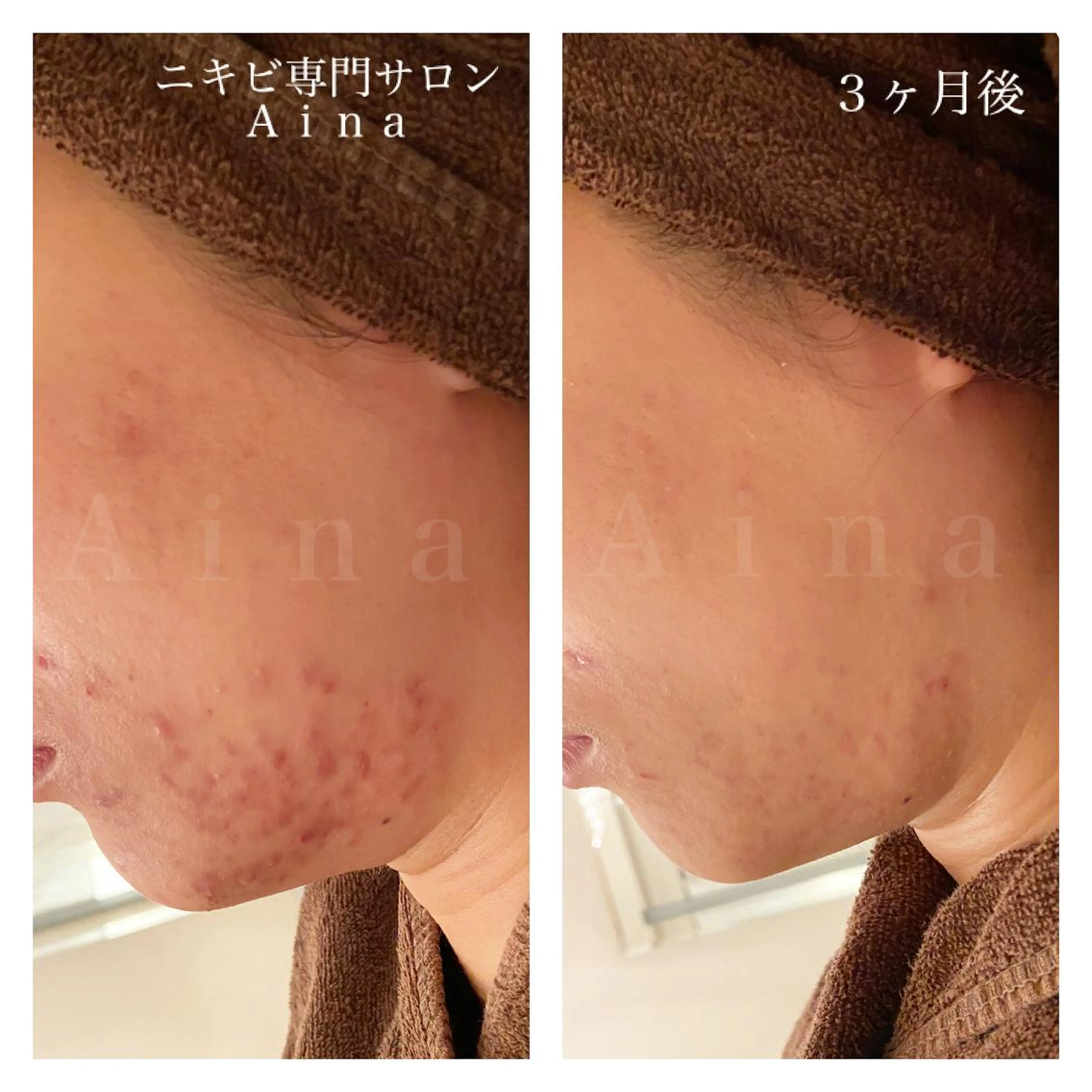 ミディアム カラー パーマ ヘアアレンジ メンズ キッズ ネイル マツエク・マツパ エステ リラク ニキビ跡専門サロン Ａｉｎａのエステ・リラクイメージ