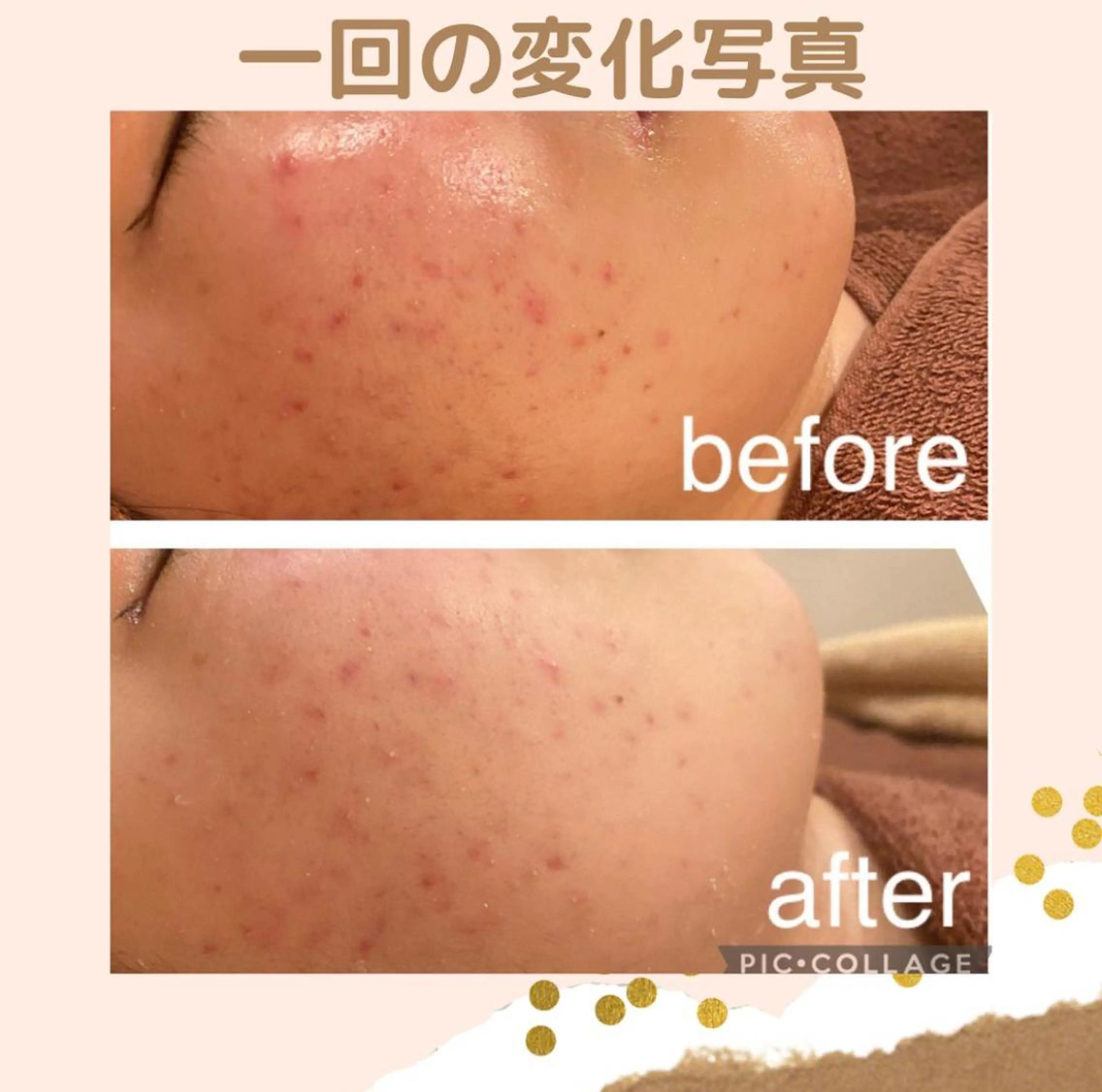 ニキビ特化型エステ 🍓最短で肌質改善のエステ・リラクイメージ