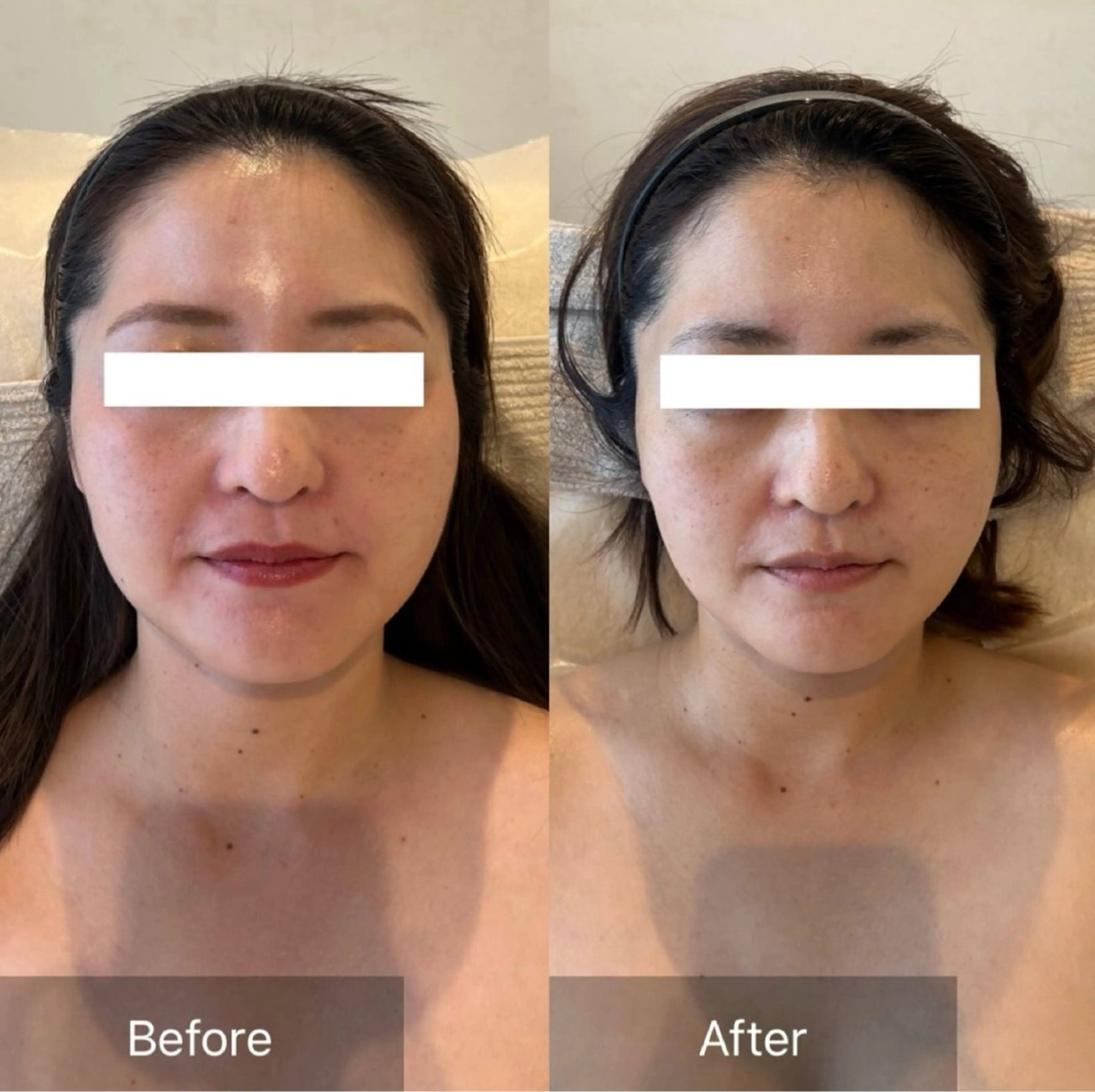 整形級小顔&ふっくらツヤ肌の写真