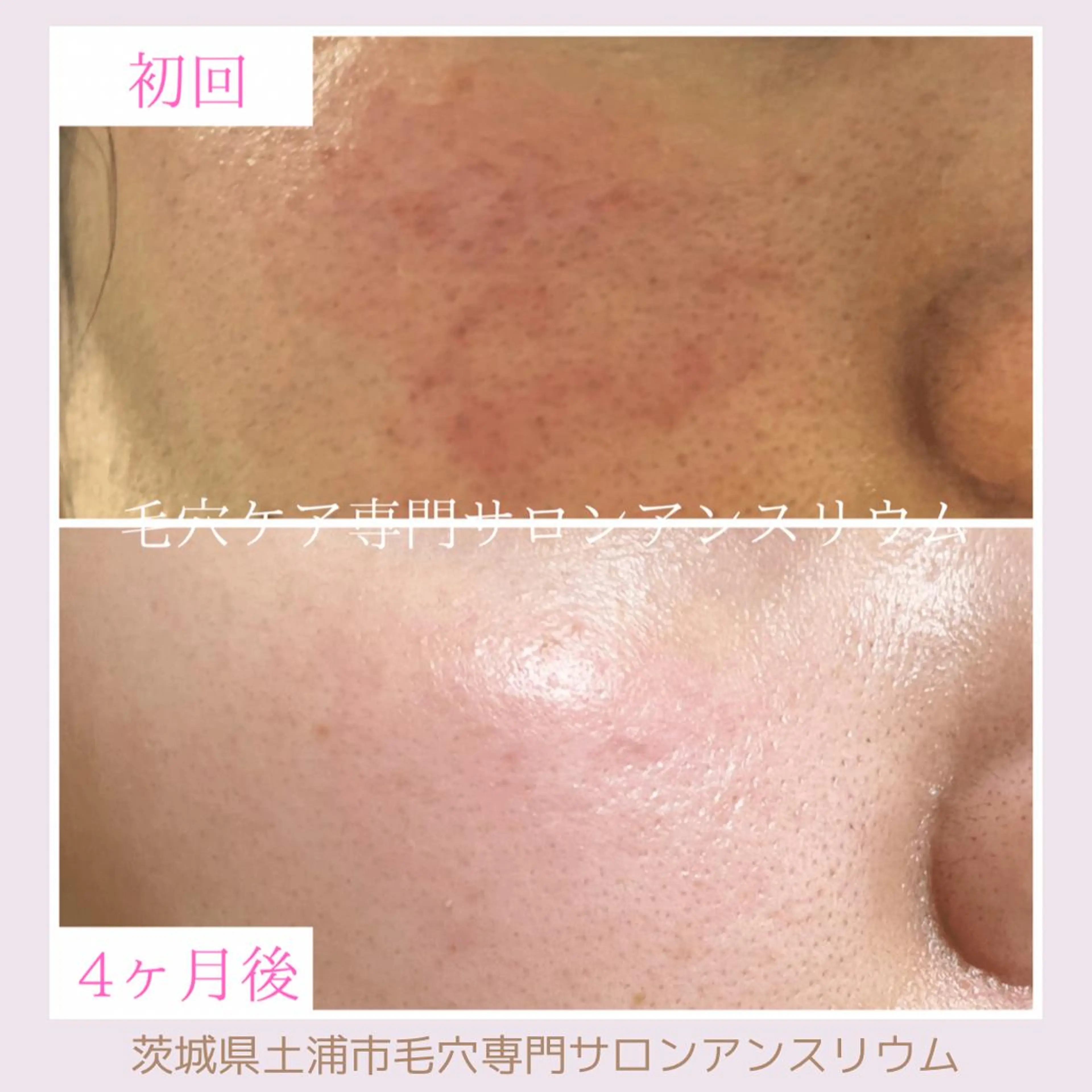 毛穴ケア専門サロンアンスリウム所属・茨城土浦 つくば毛穴 ケア専門サロンのエステ・リラクイメージ