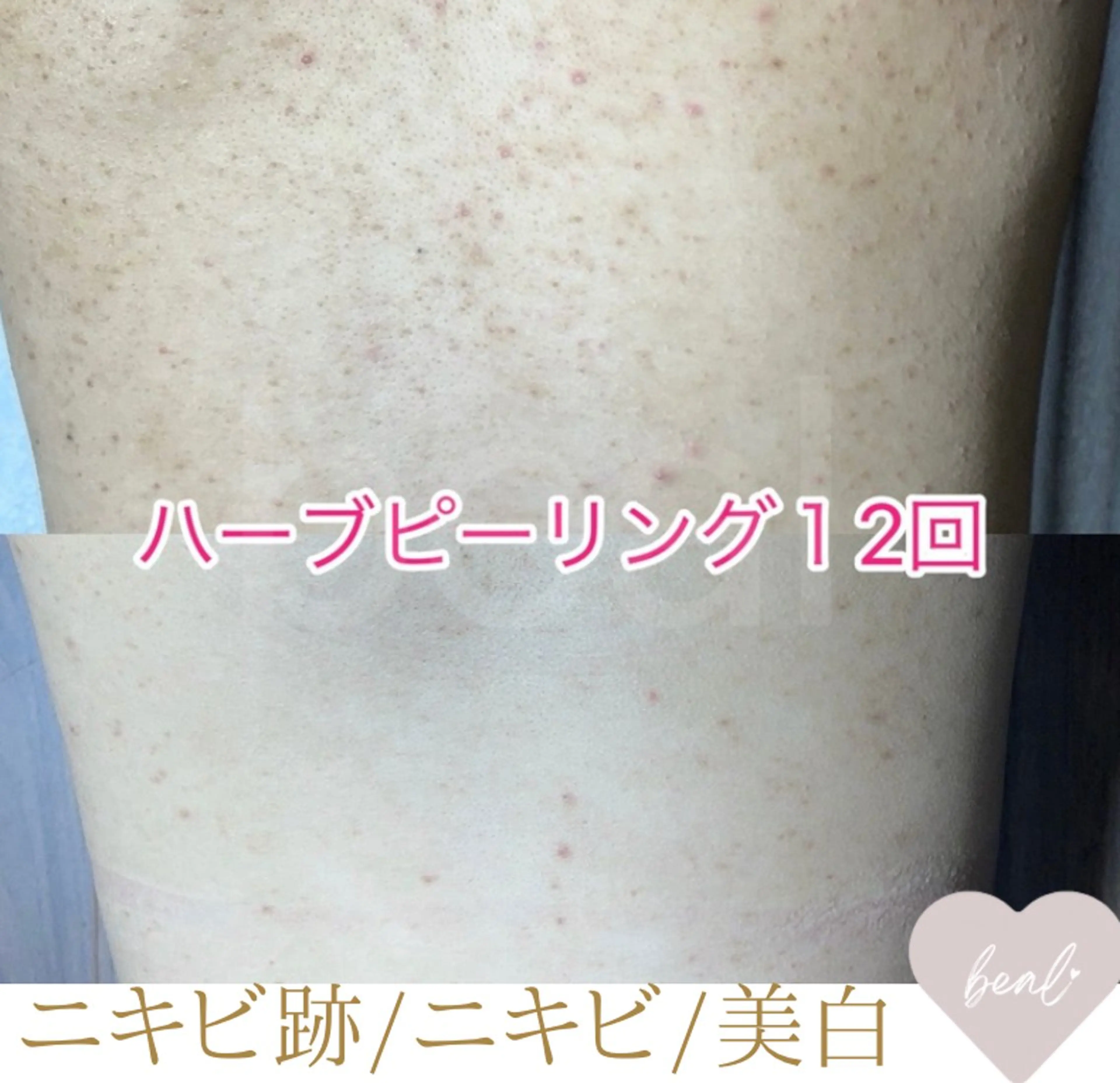 【背中の毛穴/直後につるんと透明感】上半分/剥離無ハーブピーリング¥45000→の写真