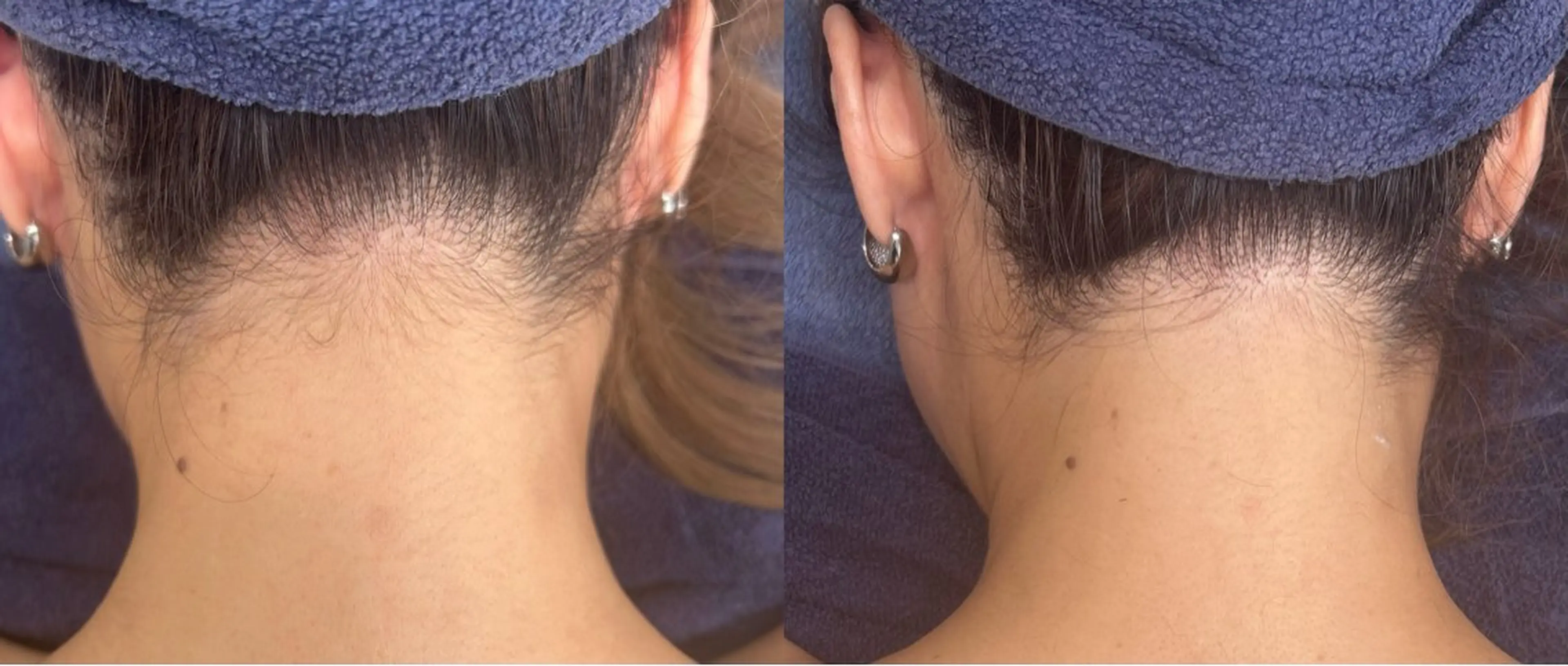 【成人式、ブライダルにオススメ】うなじ、背中全体脱毛の写真