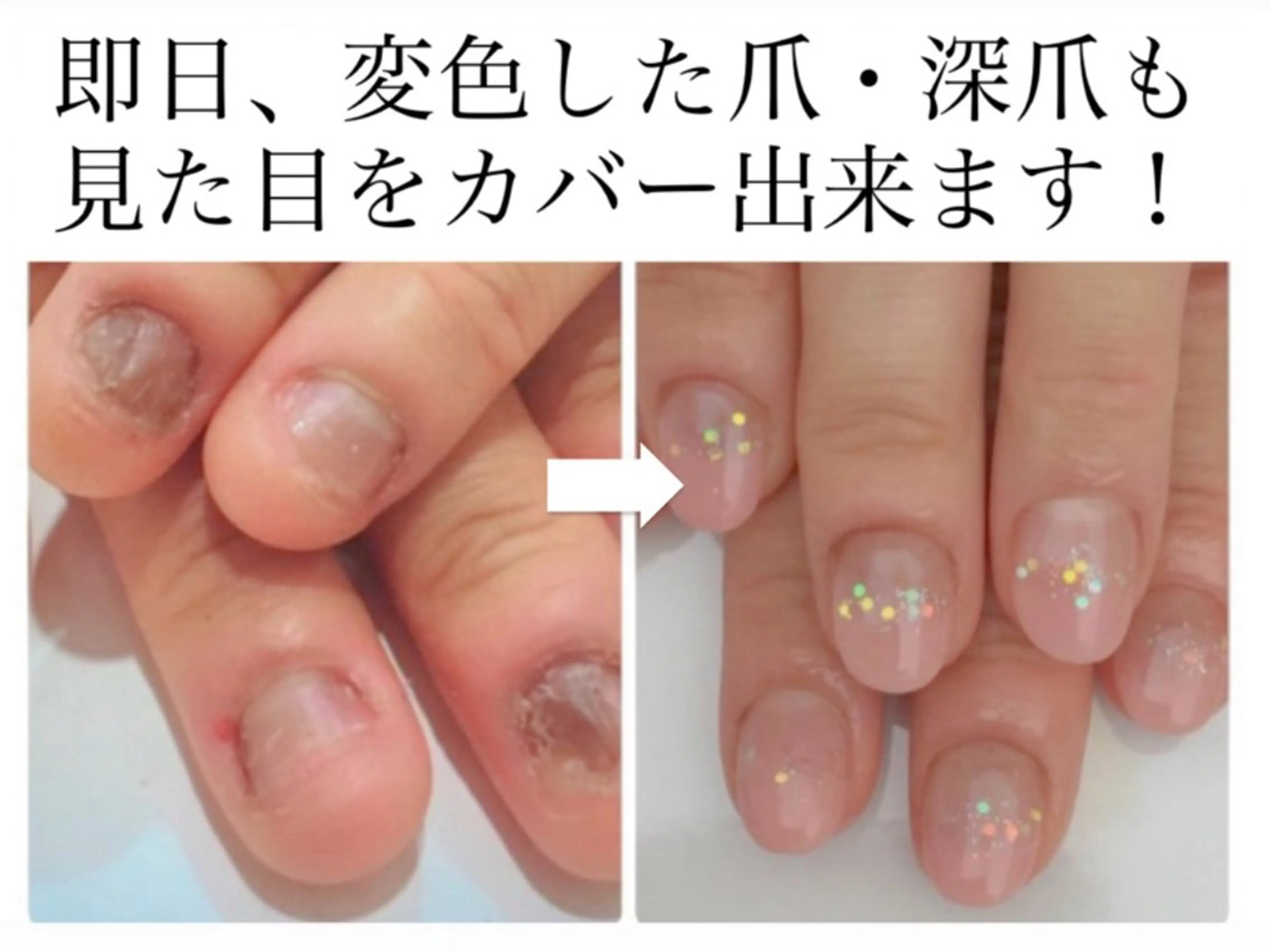 メンズ ネイル フットネイル 深爪矯正専門店　ネイルサロン　トイロ所属・ネイルサロン トイロのネイルデザイン