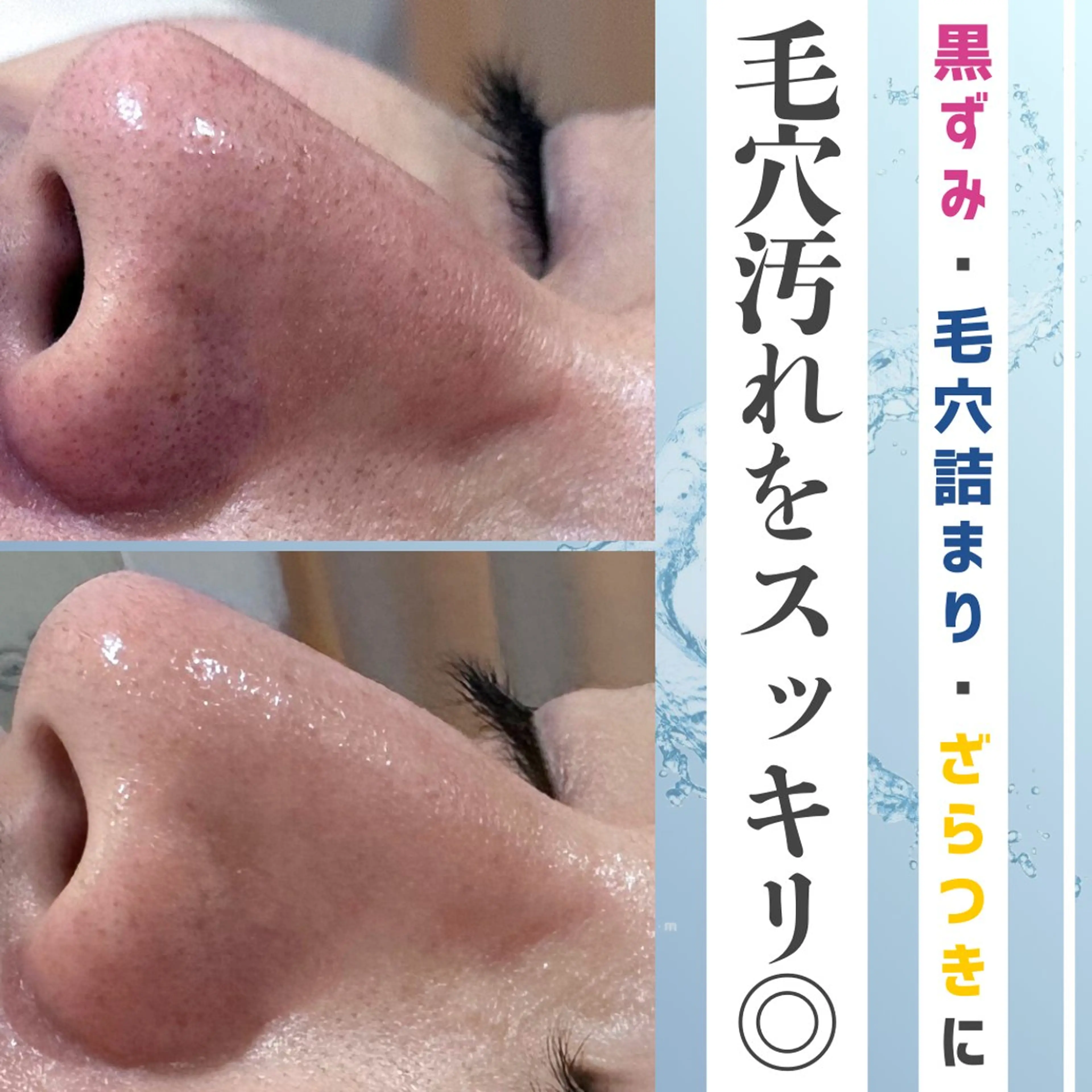 〈毛穴の黒ずみに🌟〉ハイドラフェイシャルの写真