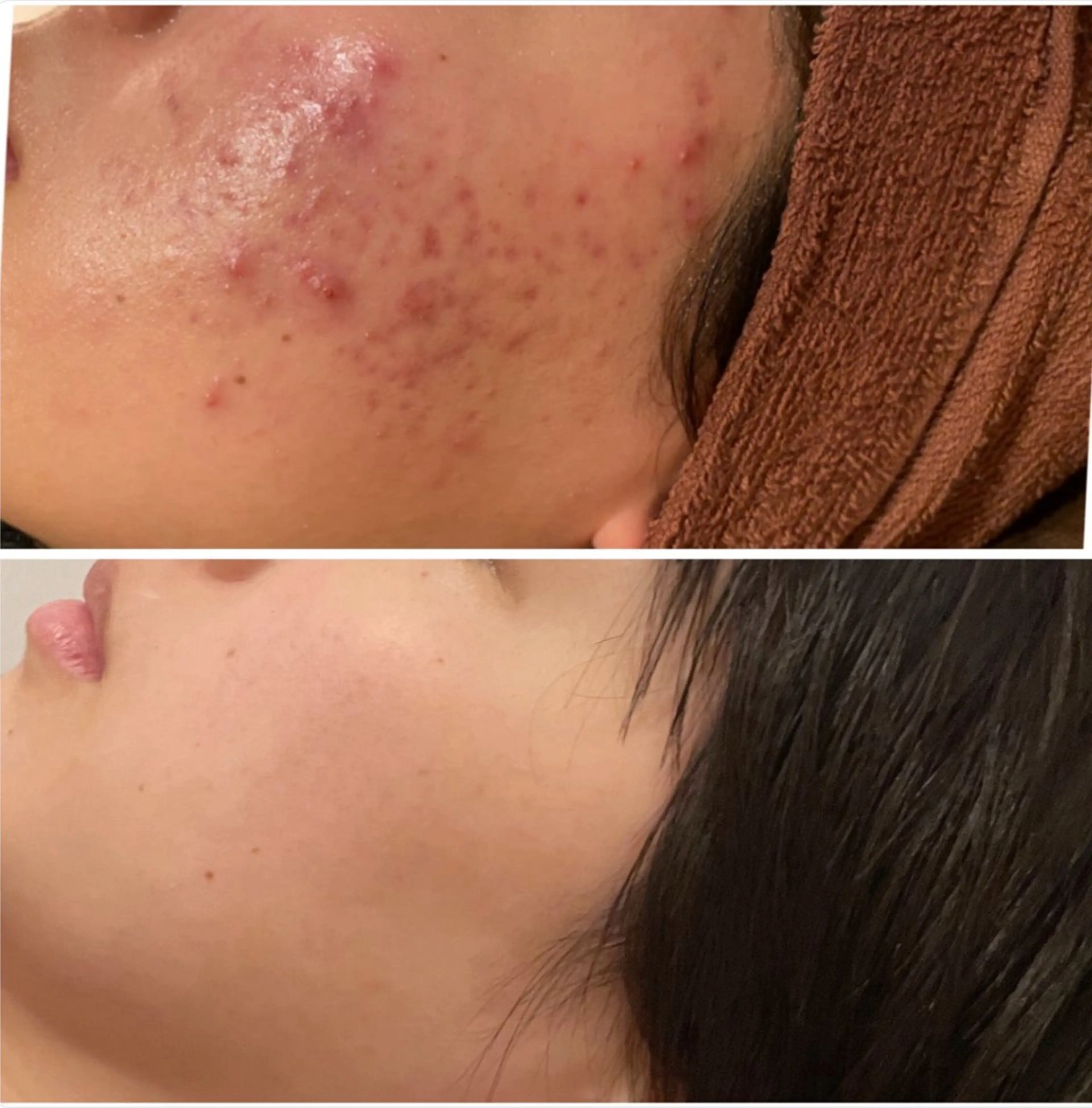 エステ リラク ニキビ特化型エステ 🍓最短で肌質改善のエステ・リラクイメージ