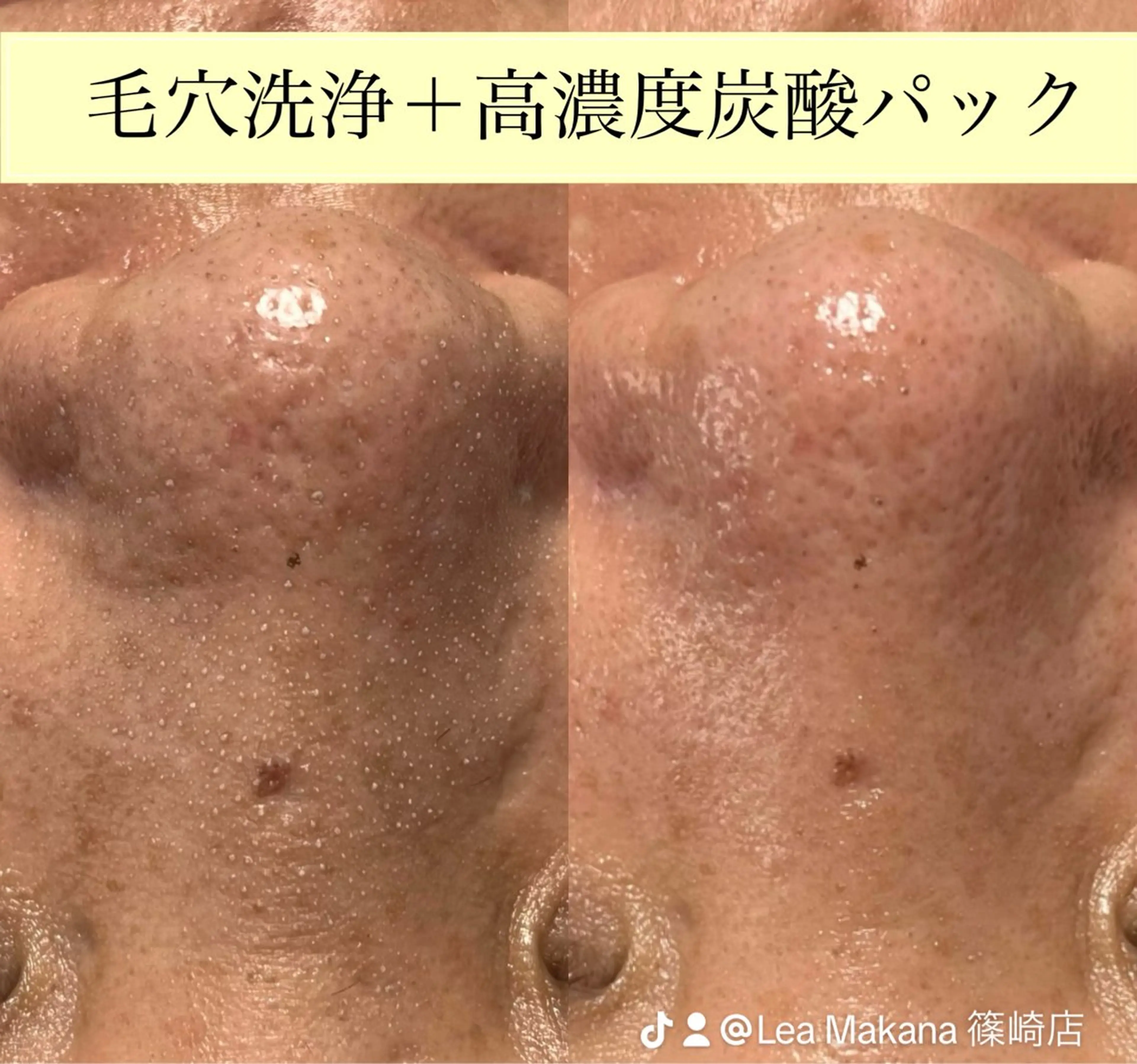 Lea Makana-レアマカナ所属・毛穴洗浄🍀脱毛🍀 光フェイシャル🍀のエステ・リラクイメージ